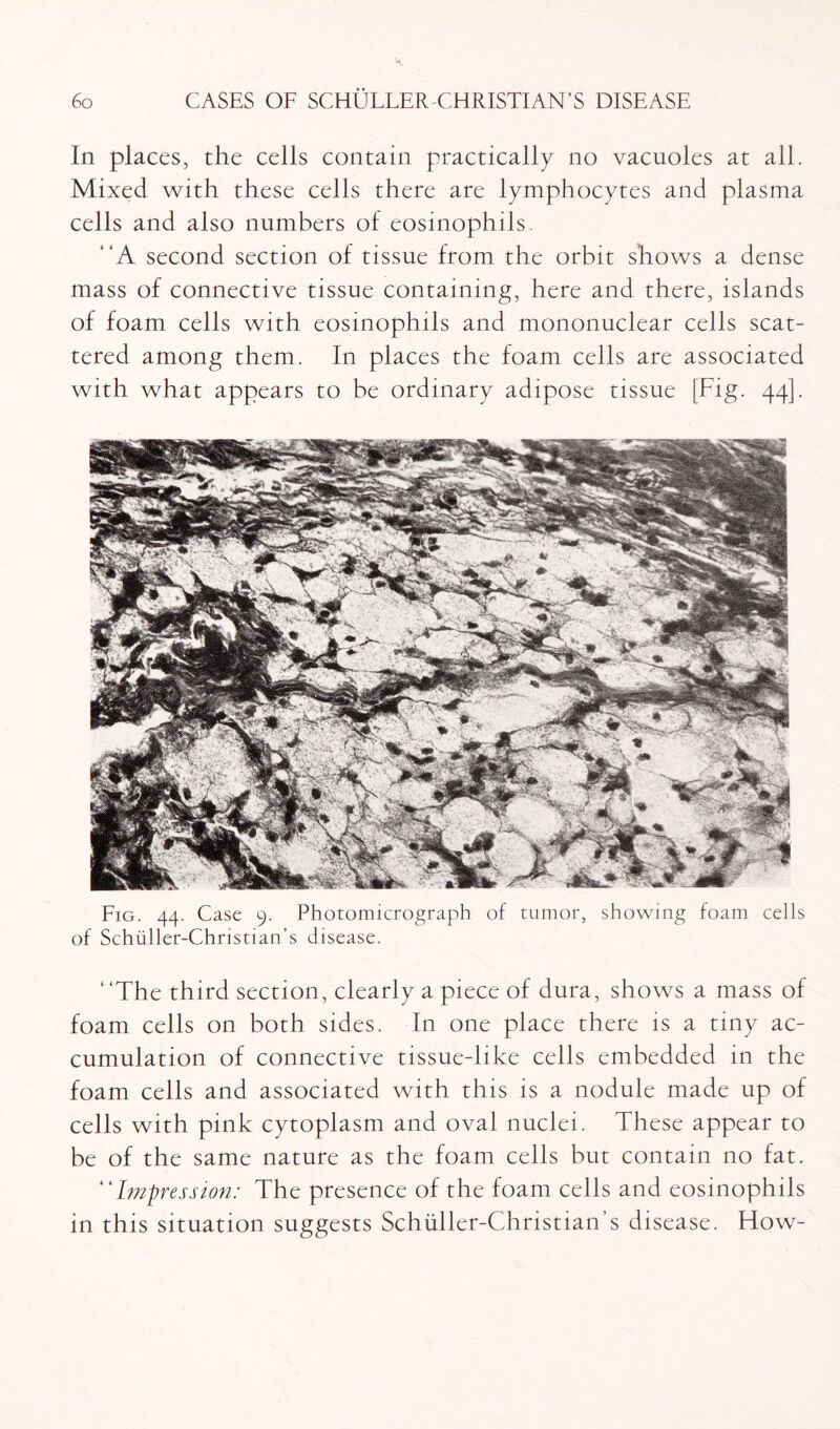 In places, the cells contain practically no vacuoles at all. Mixed with these cells there are lymphocytes and plasma cells and also numbers of eosinophils. “A second section of tissue from the orbit shows a dense mass of connective tissue containing, here and there, islands of foam cells with eosinophils and mononuclear cells scat¬ tered among them. In places the foam cells are associated with what appears to be ordinary adipose tissue [Fig- 44]. Fig. 44. Case 9. Photomicrograph of tumor, showing foam cells of Schiiller-Christian’s disease. ‘‘The third section, clearly a piece of dura, shows a mass of foam cells on both sides. In one place there is a tiny ac¬ cumulation of connective tissue-like cells embedded in the foam cells and associated with this is a nodule made up of cells with pink cytoplasm and oval nuclei. These appear to be of the same nature as the foam cells but contain no fat. Impression: The presence of the foam cells and eosinophils in this situation suggests Schuller-Christian’s disease. How-