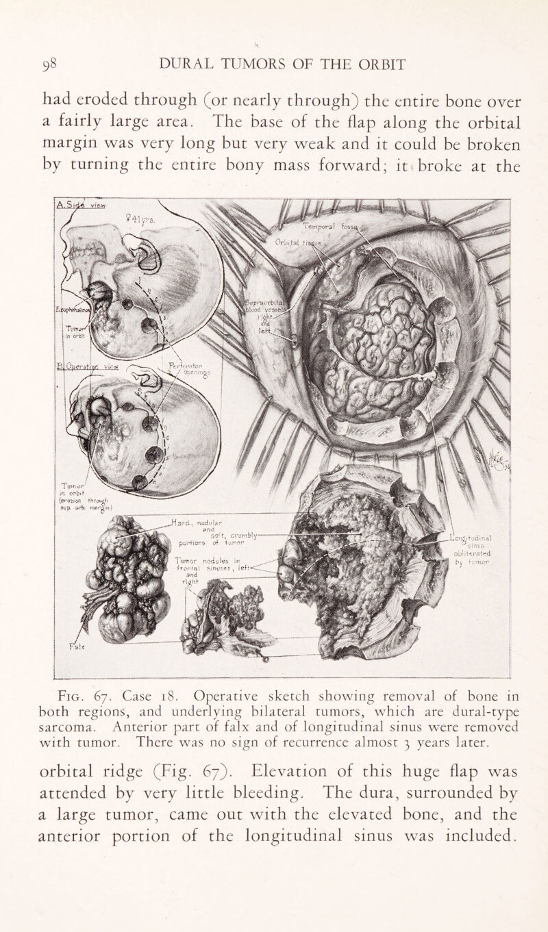 had eroded through (or nearly through) the entire bone over a fairly large area. The base of the flap along the orbital margin was very long but very weak and it could be broken by turning the entire bony mass forward; it broke at the Fig. 67. Case 18. Operative sketch showing removal of bone in both regions, and underlying bilateral tumors, which are dural-type sarcoma. Anterior part of falx and of longitudinal sinus were removed with tumor. There was no sign of recurrence almost 3 years later. orbital ridge (Fig. 67). Elevation of this huge flap was attended by very little bleeding. The dura, surrounded by a large tumor, came out with the elevated bone, and the anterior portion of the longitudinal sinus was included.