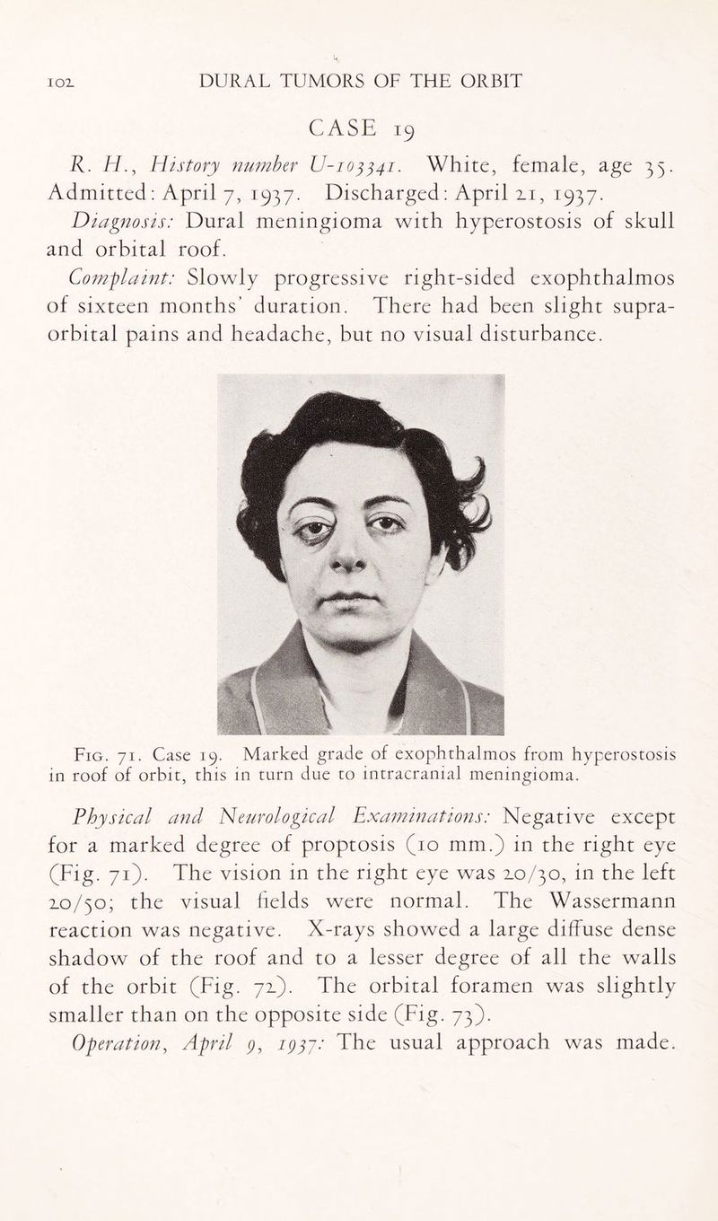 CASE 19 K. H., History number U-103341. White, female, age 35. Admitted: April 7, 1937. Discharged: April zi, 1937. Diagnosis: Dural meningioma with hyperostosis of skull and orbital roof. Complaint: Slowly progressive right-sided exophthalmos of sixteen months’ duration. There had been slight supra¬ orbital pains and headache, but no visual disturbance. Fig. 71. Case 19. Marked grade of exophthalmos from hyperostosis in roof of orbit, this in turn due to intracranial meningioma. Physical and Neurological Examinations: Negative except for a marked degree of proptosis (10 mm.) in the right eye (Fig. 71). The vision in the right eye was zo/30, in the left zo/50; the visual fields were normal. The Wassermann reaction was negative. X-rays showed a large diffuse dense shadow of the roof and to a lesser degree of all the walls of the orbit (Fig. 71C). The orbital foramen was slightly smaller than on the opposite side (Fig. 73). Operation, April 9, 1937: The usual approach was made.
