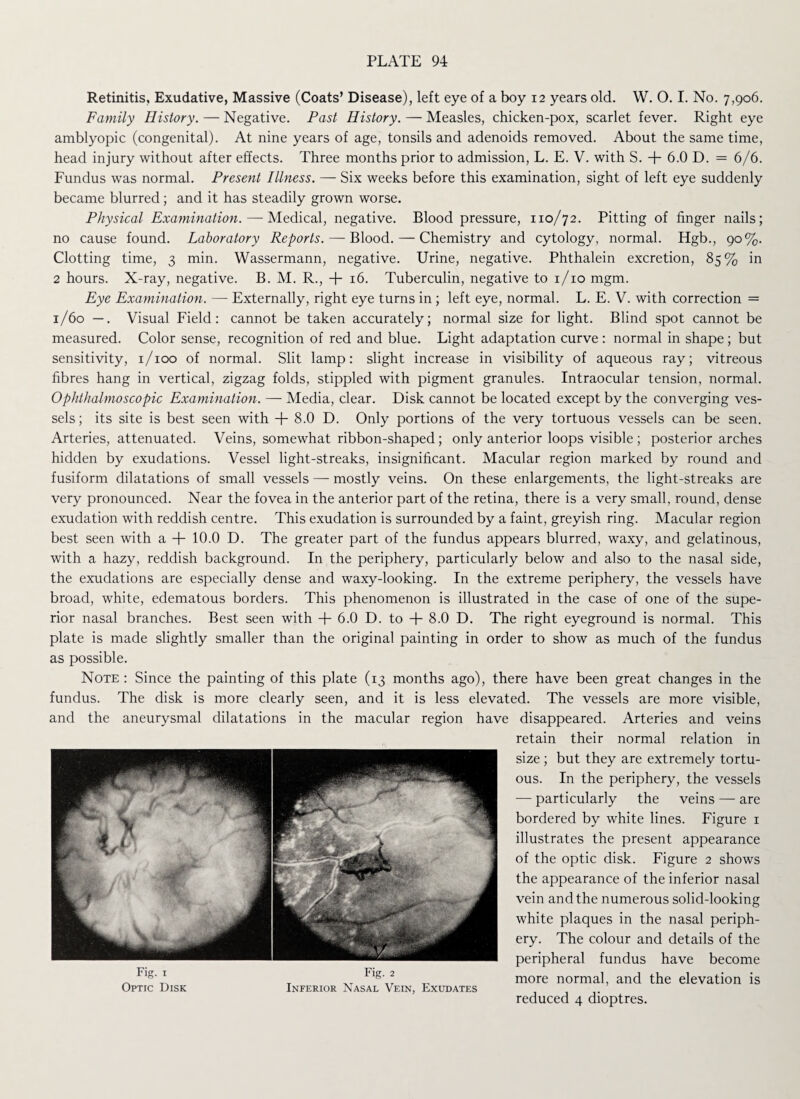 Retinitis, Exudative, Massive (Coats’ Disease), left eye of a boy 12 years old. W. O. I. No. 7,906. Family History. — Negative. Past History. — Measles, chicken-pox, scarlet fever. Right eye amblyopic (congenital). At nine years of age, tonsils and adenoids removed. About the same time, head injury without after effects. Three months prior to admission, L. E. V. with S. + 6.0 D. = 6/6. Fundus was normal. Present Illness. — Six weeks before this examination, sight of left eye suddenly became blurred; and it has steadily grown worse. Physical Examination. — Medical, negative. Blood pressure, 110/72. Pitting of finger nails; no cause found. Laboratory Reports. — Blood. — Chemistry and cytology, normal. Hgb., 90%. Clotting time, 3 min. Wassermann, negative. Urine, negative. Phthalein excretion, 85% in 2 hours. X-ray, negative. B. M. R., + 16. Tuberculin, negative to 1/10 mgm. Eye Examination. — Externally, right eye turns in ; left eye, normal. L. E. V. with correction = 1/60 —. Visual Field: cannot be taken accurately; normal size for light. Blind spot cannot be measured. Color sense, recognition of red and blue. Light adaptation curve: normal in shape; but sensitivity, 1/100 of normal. Slit lamp: slight increase in visibility of aqueous ray; vitreous fibres hang in vertical, zigzag folds, stippled with pigment granules. Intraocular tension, normal. Ophthalmoscopic Examination. — Media, clear. Disk cannot be located except by the converging ves¬ sels; its site is best seen with + 8.0 D. Only portions of the very tortuous vessels can be seen. Arteries, attenuated. Veins, somewhat ribbon-shaped ; only anterior loops visible ; posterior arches hidden by exudations. Vessel light-streaks, insignificant. Macular region marked by round and fusiform dilatations of small vessels — mostly veins. On these enlargements, the light-streaks are very pronounced. Near the fovea in the anterior part of the retina, there is a very small, round, dense exudation with reddish centre. This exudation is surrounded by a faint, greyish ring. Macular region best seen with a + 10.0 D. The greater part of the fundus appears blurred, waxy, and gelatinous, with a hazy, reddish background. In the periphery, particularly below and also to the nasal side, the exudations are especially dense and waxy-looking. In the extreme periphery, the vessels have broad, white, edematous borders. This phenomenon is illustrated in the case of one of the supe¬ rior nasal branches. Best seen with + 6.0 D. to + 8.0 D. The right eyeground is normal. This plate is made slightly smaller than the original painting in order to show as much of the fundus as possible. Note : Since the painting of this plate (13 months ago), there have been great changes in the fundus. The disk is more clearly seen, and it is less elevated. The vessels are more visible, and the aneurysmal dilatations in the macular region have disappeared. Arteries and veins retain their normal relation in size ; but they are extremely tortu¬ ous. In the periphery, the vessels — particularly the veins — are bordered by white lines. Figure 1 illustrates the present appearance of the optic disk. Figure 2 shows the appearance of the inferior nasal vein and the numerous solid-looking white plaques in the nasal periph¬ ery. The colour and details of the peripheral fundus have become _ „ T XT more normal, and the elevation is Optic Disk Inferior Nasal Vein, Exudates reduced 4 dioptres.