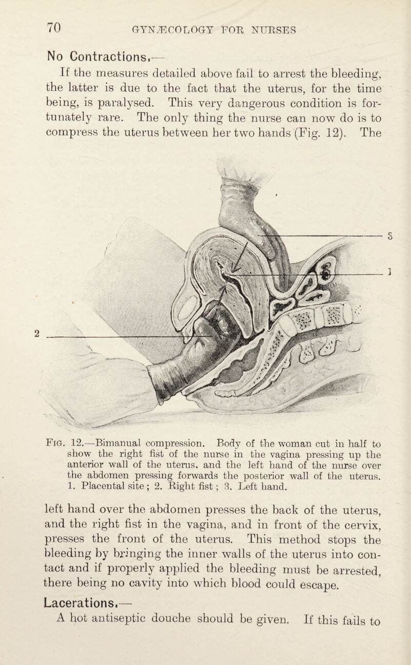 No Contractions.— If the measures detailed above fail to arrest the bleeding, the latter is due to the fact that the uterus, for the time being, is paralysed. This very dangerous condition is for¬ tunately rare. The only thing the nurse can now do is to compress the uterus between her two hands (Fig. 12). The Fig. 12.—Bimanual compression. Body of the woman cut in half to show the right fist of the nurse in the vagina pressing up the anterior wall of the uterus, and the left hand of the nurse over the abdomen pressing forwards the posterior wall of the uterus. 1. Placental site; 2. Right fist; 8. Left hand. left hand over the abdomen presses the back of the uterus, and the right fist in the vagina, and in front of the cervix, presses the front of the uterus. This method stops the bleeding by bringing the inner walls of the uterus into con¬ tact and if properly applied the bleeding must be arrested, there being no cavity into which blood could escape. Lacerations.— A hot antiseptic douche should be given. If this fails to