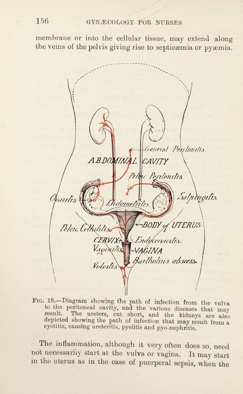 membrane or into the cellular tissue, may extend along the veins of the pelvis giving rise to septicaemia or pyaemia. Fig. 18.—Diagram showing the path of infection from the vulva to the peritoneal cavity, and the various diseases that may result. The ureters, cut short, and the kidneys are also depicted showing the path of infection that may result from a cystitis, causing ureteritis, pyelitis and pyo-nephritis. The inflammation, although it very often does so, need not necessarily start at the vulva or vagina. It may start in the uterus as in the case of puerperal sepsis, when the