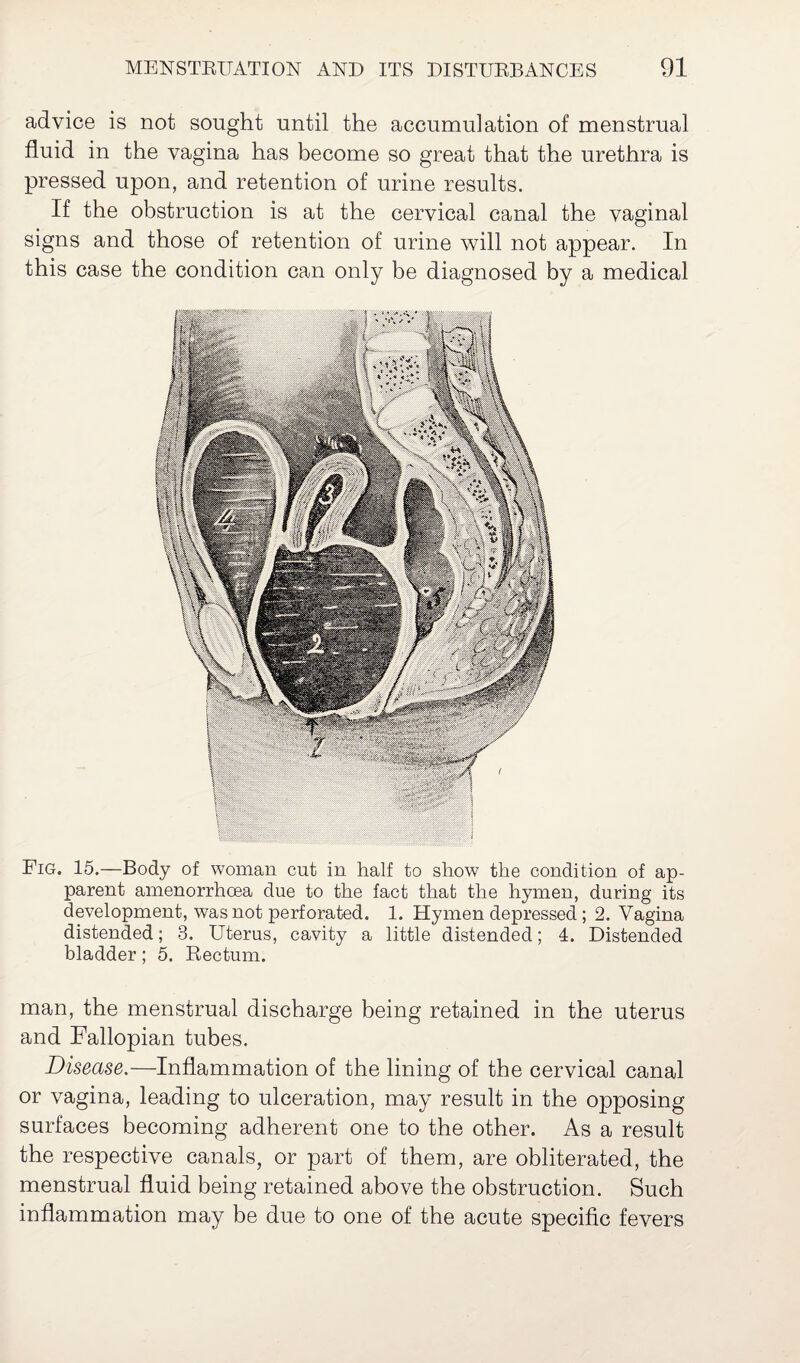 advice is not sought until the accumulation of menstrual fluid in the vagina has become so great that the urethra is pressed upon, and retention of urine results. If the obstruction is at the cervical canal the vaginal signs and those of retention of urine will not appear. In this case the condition can only be diagnosed by a medical Fig. 15.—Body of woman cut in half to show the condition of ap¬ parent amenorrhcea due to the fact that the hymen, during its development, was not perforated. 1. Hymen depressed ; 2. Vagina distended; 3. Uterus, cavity a little distended; 4. Distended bladder; 5. Rectum. man, the menstrual discharge being retained in the uterus and Fallopian tubes. Disease.—Inflammation of the lining of the cervical canal or vagina, leading to ulceration, may result in the opposing surfaces becoming adherent one to the other. As a result the respective canals, or part of them, are obliterated, the menstrual fluid being retained above the obstruction. Such inflammation may be due to one of the acute specific fevers