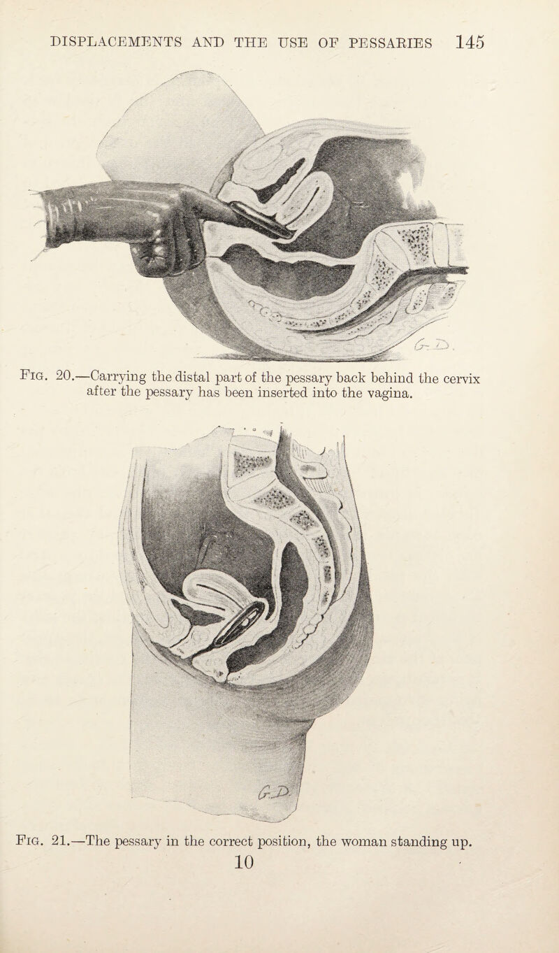 Pig. 20.—Carrying the distal part of the pessary back behind the cervix after the pessary has been inserted into the vagina.