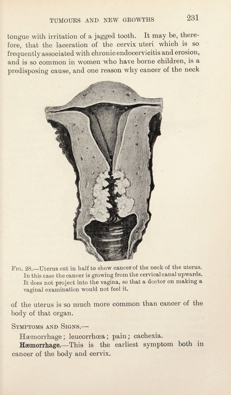 Fig. 28.—Uterus cut in half to show cancer of the neck of the uterus. In this case the cancer is growing from the cervical canal upwards. It does not project into the vagina, so that a doctor on making a vaginal examination would not feel it. of the uterus is so much more common than cancer of the body of that organ. Symptoms and Signs.— Haemorrhage ; leucorrhoea ; pain; cachexia. Haemorrhage.—This is the earliest symptom both in cancer of the body and cervix. tongue with irritation of a jagged tooth. It may be, there¬ fore, that the laceration of the cervix uteri which is so frequently associated with chronic endocervicitis and erosion, and is so common in women who have borne children, is a predisposing cause, and one reason why cancer of the neck