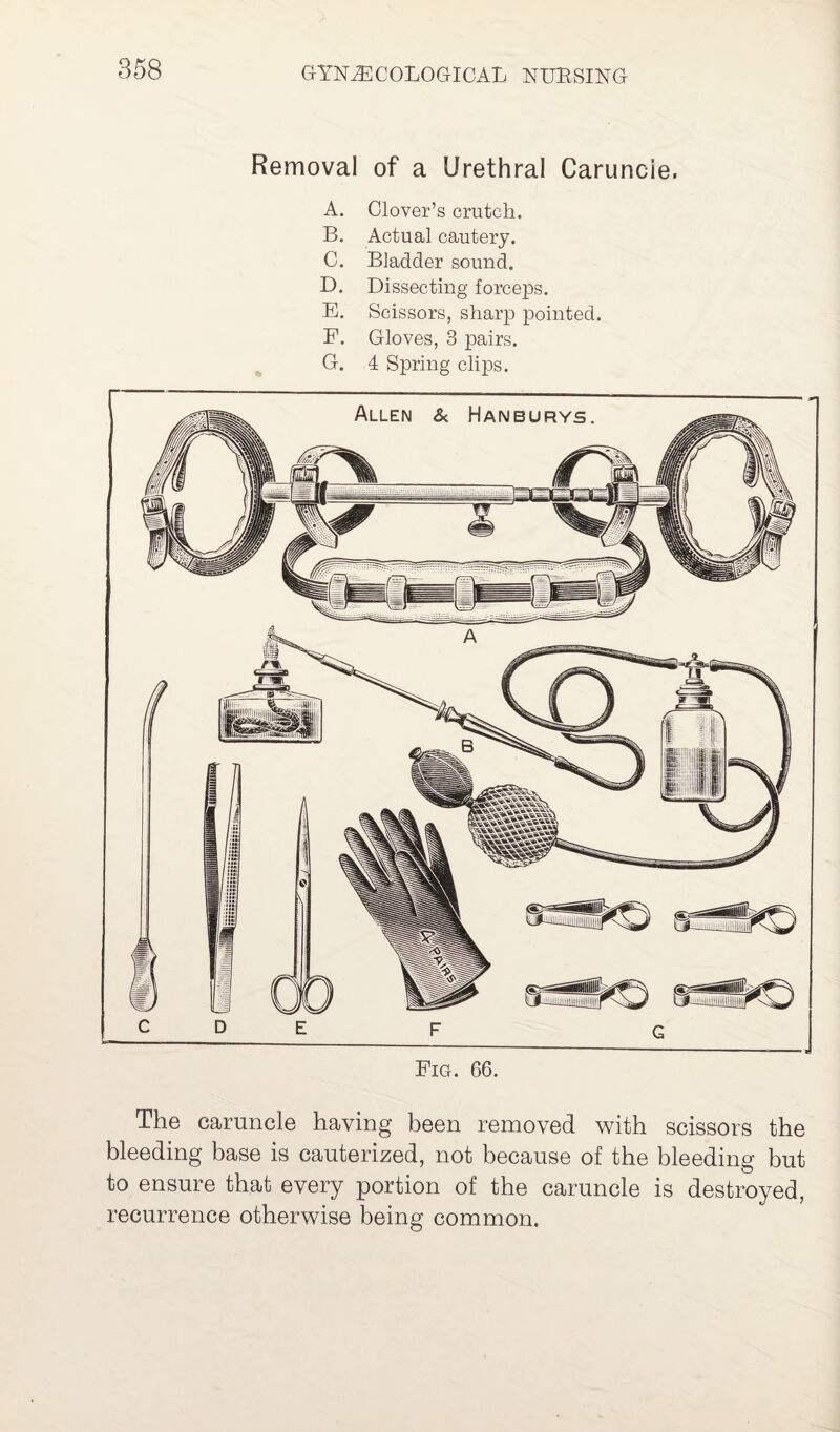 Removal of a Urethral Caruncie. A. Clover’s crutch. B. Actual cautery. C. Bladder sound. D. Dissecting forceps. E. Scissors, sharp pointed. F. Gloves, 3 pairs. G. 4 Spring clips. c D E F G Fig. 66. The caruncle having been removed with scissors the bleeding base is cauterized, not because of the bleeding but to ensure that every portion of the caruncle is destroyed, recurrence otherwise being common.