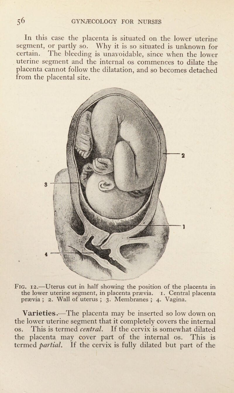 In this case the placenta is situated on the lower uterine segment, or partly so. Why it is so situated is unknown for certain. The bleeding is unavoidable, since when the lower uterine segment and the internal os commences to dilate the placenta cannot follow the dilatation, and so becomes detached from the placental site. Fig. 12.—Uterus cut in half showing the position of the placenta in the lower uterine segment, in placenta praevia. i. Central placenta praevia ; 2. Wall of uterus ; 3. Membranes ; 4. Vagina. Varieties.'—The placenta may be inserted so low down on the lower uterine segment that it completely covers the internal os. This is termed central. If the cervix is somewhat dilated the placenta may cover part of the internal os. This is termed partial. If the cervix is fully dilated but part of the