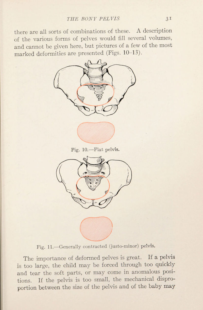 there are all sorts of combinations of these. A description of the various forms of pelves would fill several volumes, and cannot be given here, but pictures of a few of the most marked deformities are presented (Figs. 10-13). Fig. 11.—Generally contracted (justo-minor) pelvis. The importance of deformed pelves is great. If a pelvis is too large, the child may be forced through too quickly and tear the soft parts, or may come in anomalous posi¬ tions. If the pelvis is too small, the mechanical dispro¬ portion between the size of the pelvis and of the baby may