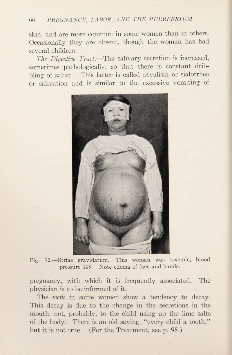 skin, and are more common in some women than in others. Occasionally they are absent, though the woman has had several children. The Digestive Tract.—The salivary secretion is increased, sometimes pathologically, so that there is constant drib¬ bling of saliva. This latter is called ptyalism or sialorrhea or salivation and is similar to the excessive vomiting of Fig. 32.—Striae gravidarum. This woman was toxemic, blood pressure 145. Note edema of face and hands. pregnancy, with which it is frequently associated. The physician is to be informed of it. The teeth in some women show a tendency to decay. This decay is due to the change in the secretions in the mouth, not, probably, to the child using up the lime salts of the body. There is an old saying, “every child a tooth,” but it is not true. (For the Treatment, see p. 95.)