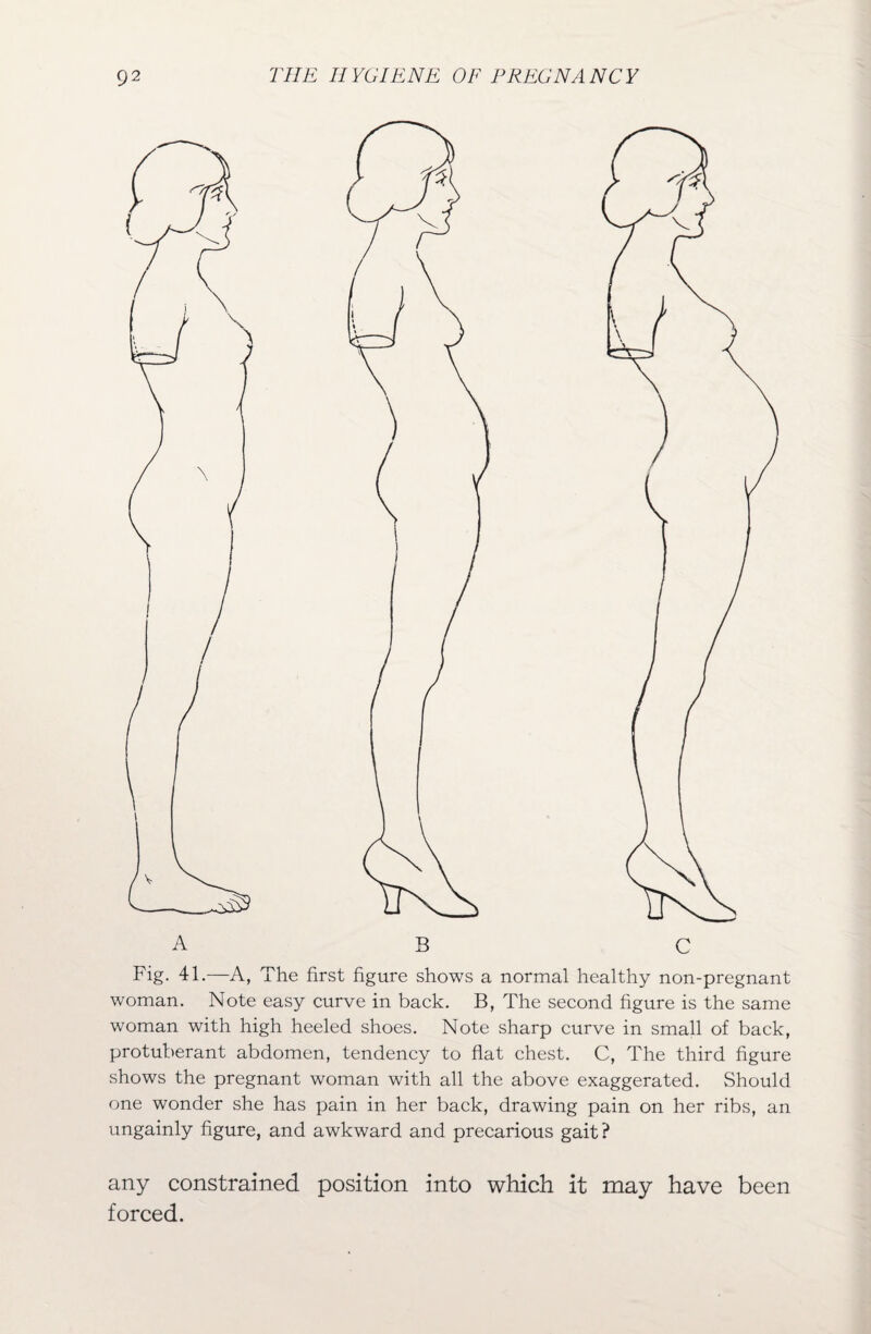 Fig. 41.—A, The first figure shows a normal healthy non-pregnant woman. Note easy curve in back. B, The second figure is the same woman with high heeled shoes. Note sharp curve in small of back, protuberant abdomen, tendency to flat chest. C, The third figure shows the pregnant woman with all the above exaggerated. Should one wonder she has pain in her back, drawing pain on her ribs, an ungainly figure, and awkward and precarious gait? any constrained position into which it may have been forced.
