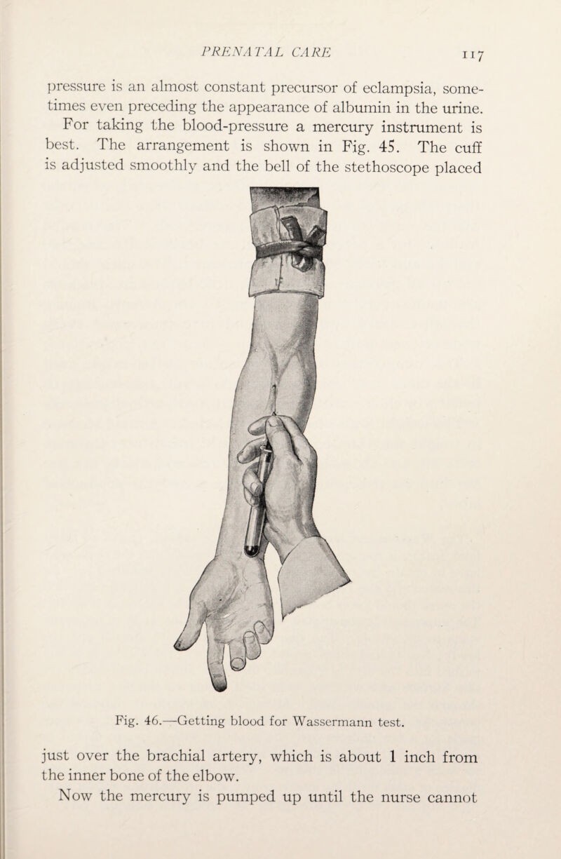 pressure is an almost constant precursor of eclampsia, some¬ times even preceding the appearance of albumin in the urine. For taking the blood-pressure a mercury instrument is best. The arrangement is shown in Fig. 45. The cuff is adjusted smoothly and the bell of the stethoscope placed Fig. 46.—Getting blood for Wassermann test. just over the brachial artery, which is about 1 inch from the inner bone of the elbow. Now the mercury is pumped up until the nurse cannot
