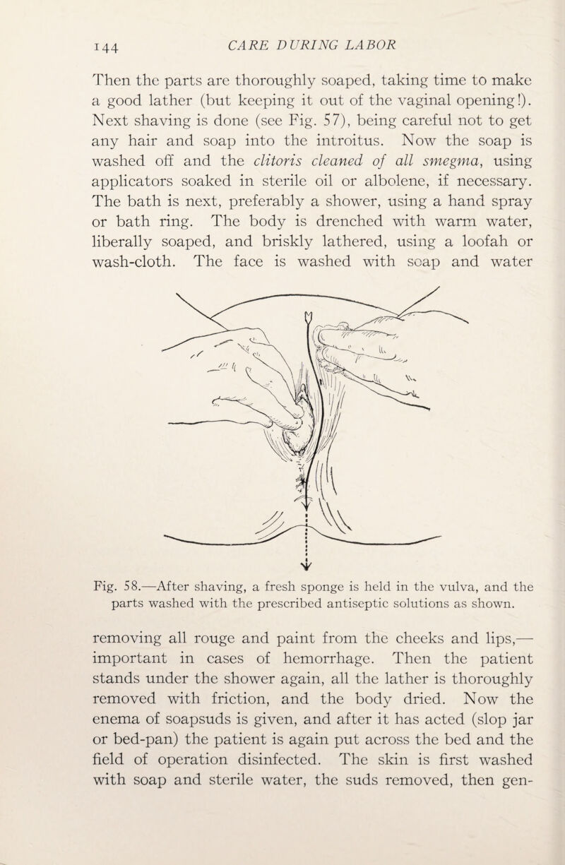 Then the parts are thoroughly soaped, taking time to make a good lather (but keeping it out of the vaginal opening!). Next shaving is done (see Fig. 57), being careful not to get any hair and soap into the introitus. Now the soap is washed off and the clitoris cleaned of all smegma, using applicators soaked in sterile oil or albolene, if necessary. The bath is next, preferably a shower, using a hand spray or bath ring. The body is drenched with warm water, liberally soaped, and briskly lathered, using a loofah or wash-cloth. The face is washed with soap and water Fig. 58.—After shaving, a fresh sponge is held in the vulva, and the parts washed with the prescribed antiseptic solutions as shown. removing all rouge and paint from the cheeks and lips,— important in cases of hemorrhage. Then the patient stands under the shower again, all the lather is thoroughly removed with friction, and the body dried. Now the enema of soapsuds is given, and after it has acted (slop jar or bed-pan) the patient is again put across the bed and the field of operation disinfected. The skin is first washed with soap and sterile water, the suds removed, then gen-