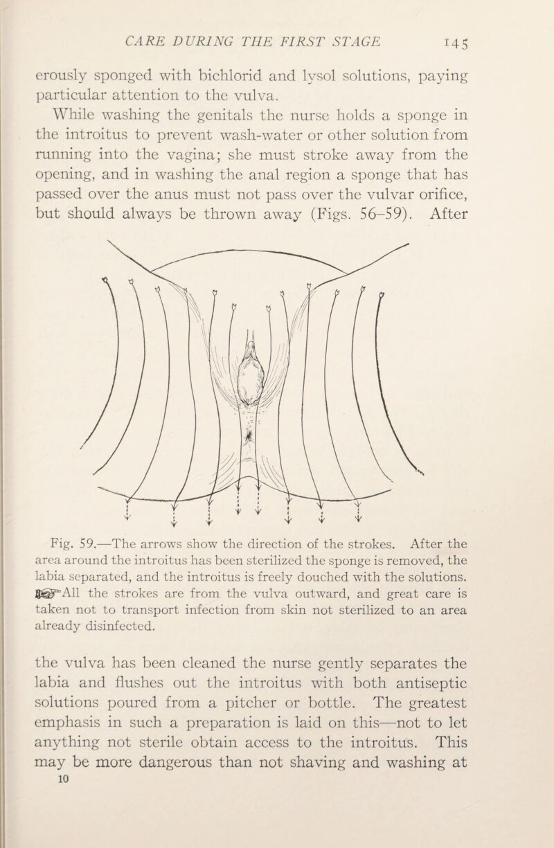 erously sponged with bichlorid and lvsol solutions, paying particular attention to the vulva. While washing the genitals the nurse holds a sponge in the introitus to prevent wash-water or other solution from running into the vagina; she must stroke away from the opening, and in washing the anal region a sponge that has passed over the anus must not pass over the vulvar orifice, but should always be thrown away (Figs. 56-59). After Fig. 59.—The arrows show the direction of the strokes. After the area around the introitus has been sterilized the sponge is removed, the labia separated, and the introitus is freely douched with the solutions. 8^°All the strokes are from the vulva outward, and great care is taken not to transport infection from skin not sterilized to an area already disinfected. the vulva has been cleaned the nurse gently separates the labia and flushes out the introitus with both antiseptic solutions poured from a pitcher or bottle. The greatest emphasis in such a preparation is laid on this—not to let anything not sterile obtain access to the introitus. This may be more dangerous than not shaving and washing at 10