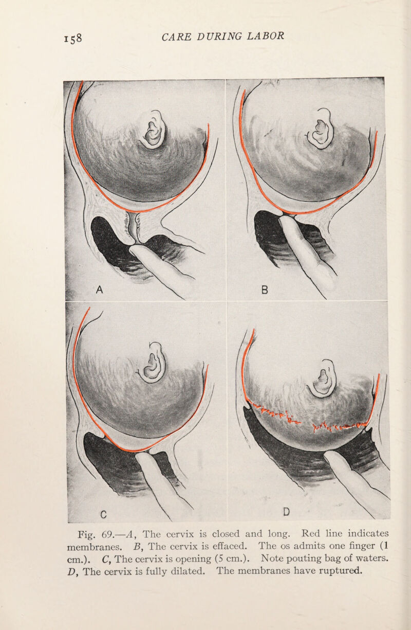 Fig. 69.—A, The cervix is closed and long. Red line indicates membranes. B, The cervix is effaced. The os admits one finger (1 cm.). C, The cervix is opening (5 cm.). Note pouting bag of waters. D, The cervix is fully dilated. The membranes have ruptured.