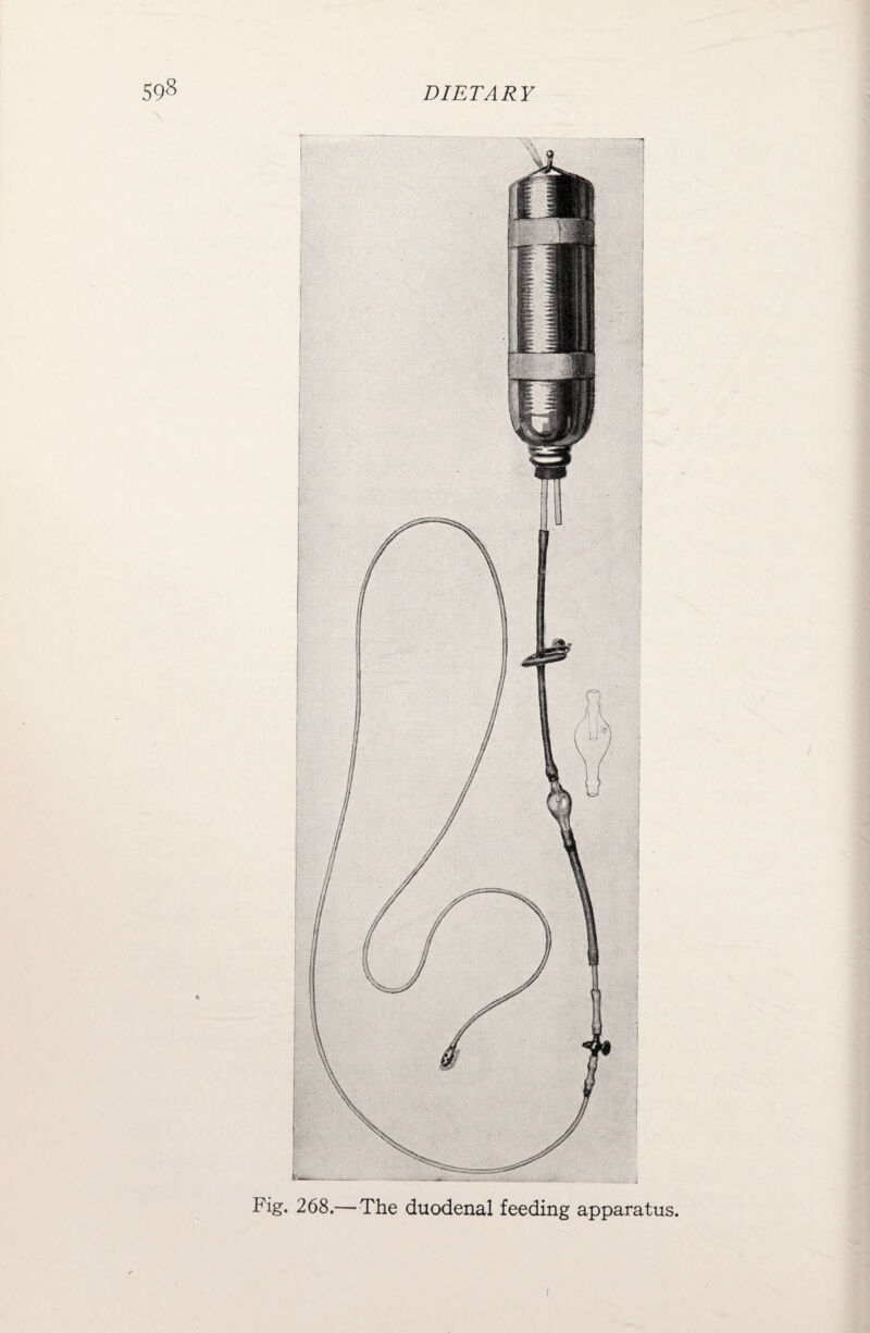 Fig. 268.— The duodenal feeding apparatus. I