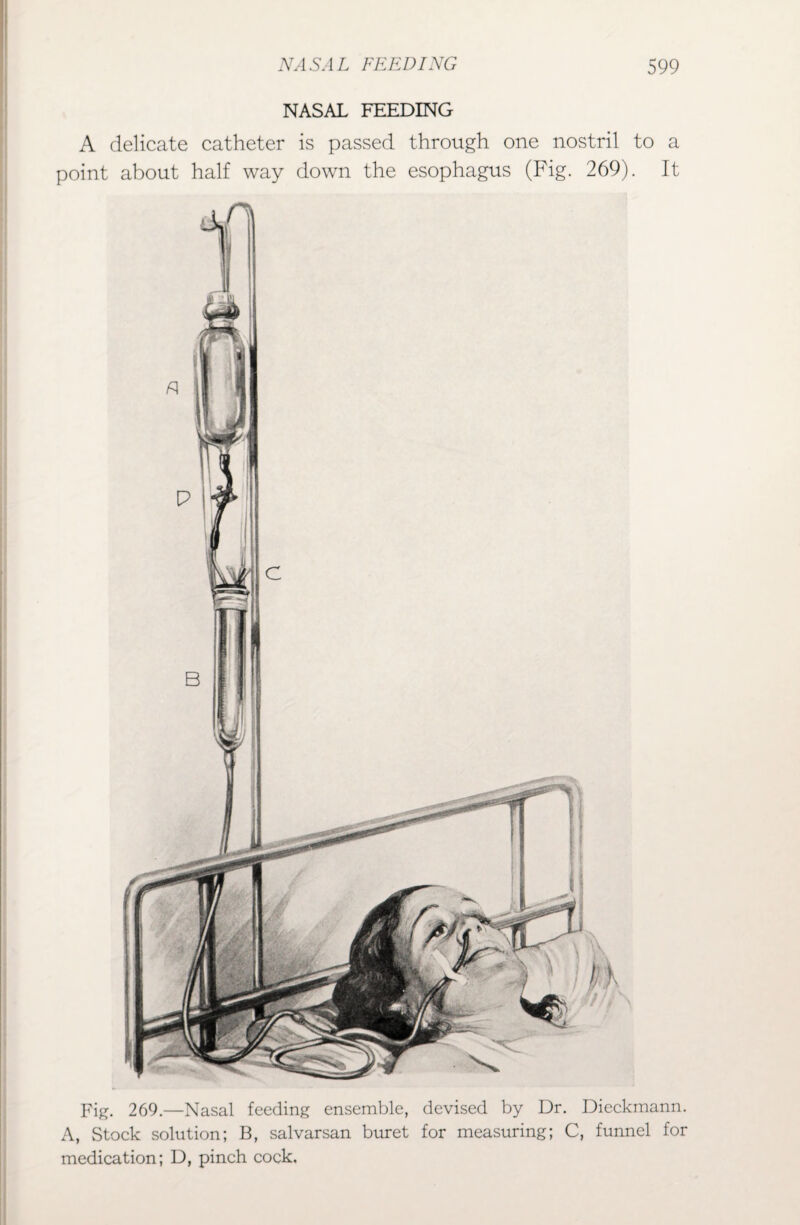 NASAL FEEDING A delicate catheter is passed through one nostril to a point about half way down the esophagus (Fig. 269). It Fig. 269.—Nasal feeding ensemble, devised by Dr. Dieckmann. A, Stock solution; B, salvarsan buret for measuring; C, funnel for medication; D, pinch cock.