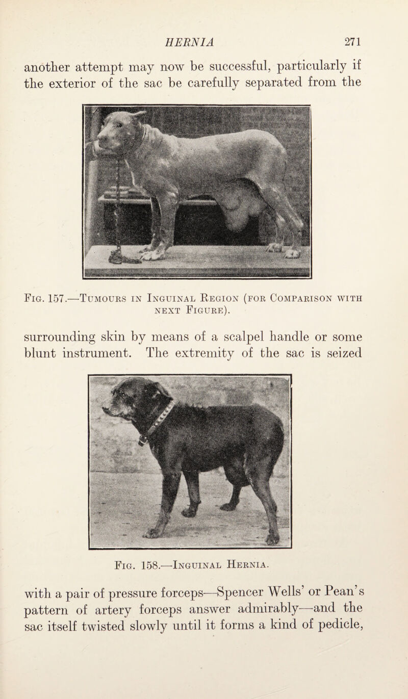 another attempt may now be successful, particularly if the exterior of the sac be carefully separated from the Fig. 157.—Tumours in Inguinal Region (for Comparison with next Figure). surrounding skin by means of a scalpel handle or some blunt instrument. The extremity of the sac is seized Fig. 158.—Inguinal Hernia. with a pair of pressure forceps—Spencer Wells’ or Pean s pattern of artery forceps answer admirably—and the sac itself twisted slowly until it forms a kind of pedicle,