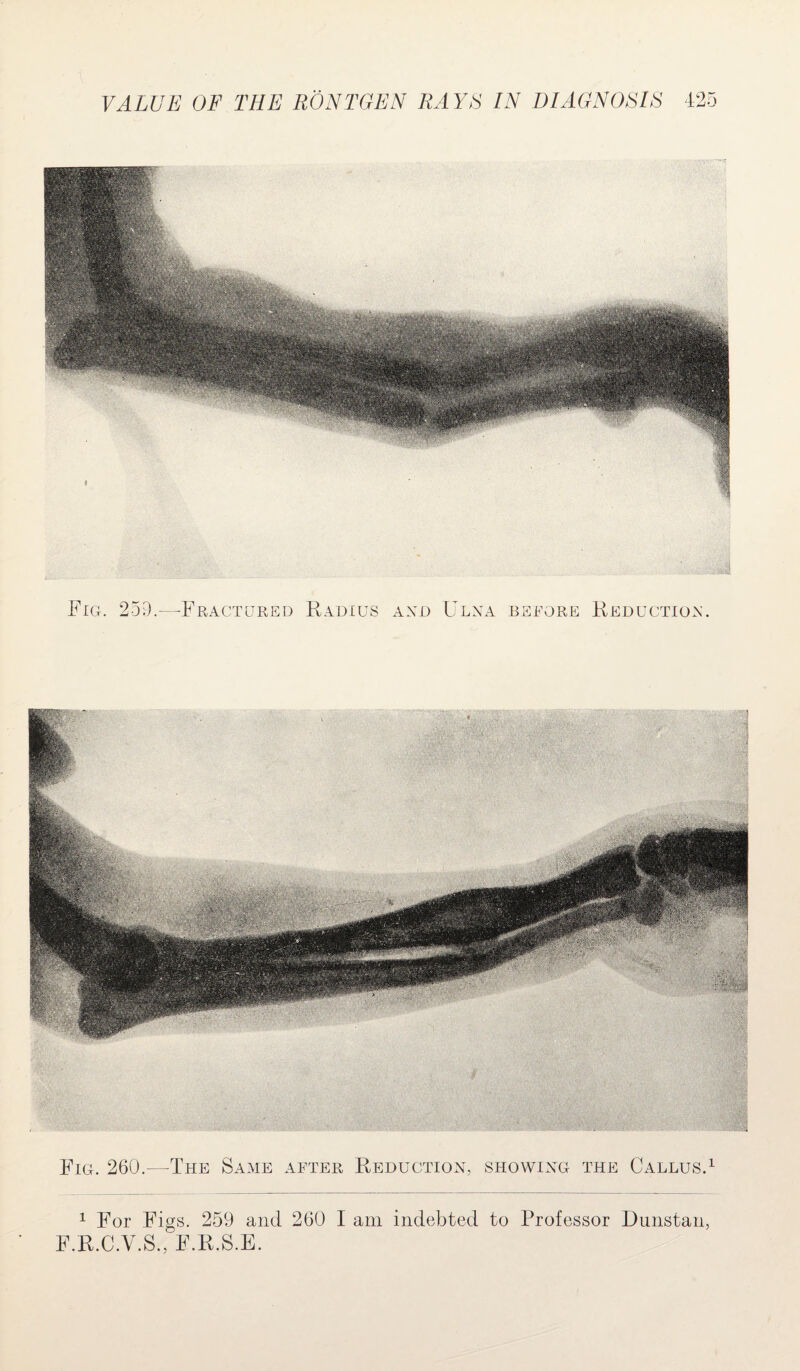 Fig. 259.—Fractured Radius AXd Ulna bstore Reduction. Fig. 260.—The Same after Reduction, showing the Callus.1 1 For Figs. 259 and 260 I am indebted to Professor Dunstan, F.R.C.Y.S., F.R.S.E.