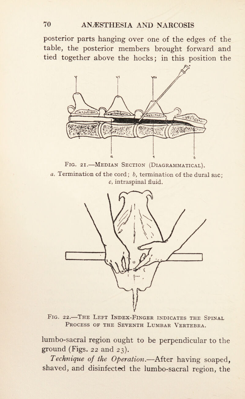 posterior parts hanging over one of the edges of the table, the posterior members brought forward and tied together above the hocks; in this position the Fig. 21.—Median Section (Diagrammatical). a, Termination of the cord; b, termination of the dural sac; c, intraspinal fluid. Fig. 22.—The Left Index-Finger indicates the Spinal Process of the Seventh Lumbar Vertebra. lumbo-sacral region ought to be perpendicular to the ground (Figs. 22 and 23). Technique of the Operation.—After having soaped, shaved, and disinfected the lumbo-sacral region, the