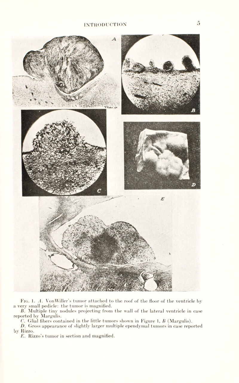 Fig. 1. .1. VonWiller s tumor attached to the roof of the Hour of the ventricle by a very small pedicle: the tumor is magnified. B. Multiple tiny nodules projecting from the wall of the lateral ventricle in case reported by Margulis. (dial fibers contained in the little tumors shown in Figure 1, B (Margulis). 1). Gross appearance of slightly larger multiple ependymal tumors in case reported by Rizzo. Rizzo’s tumor in section and magnified.