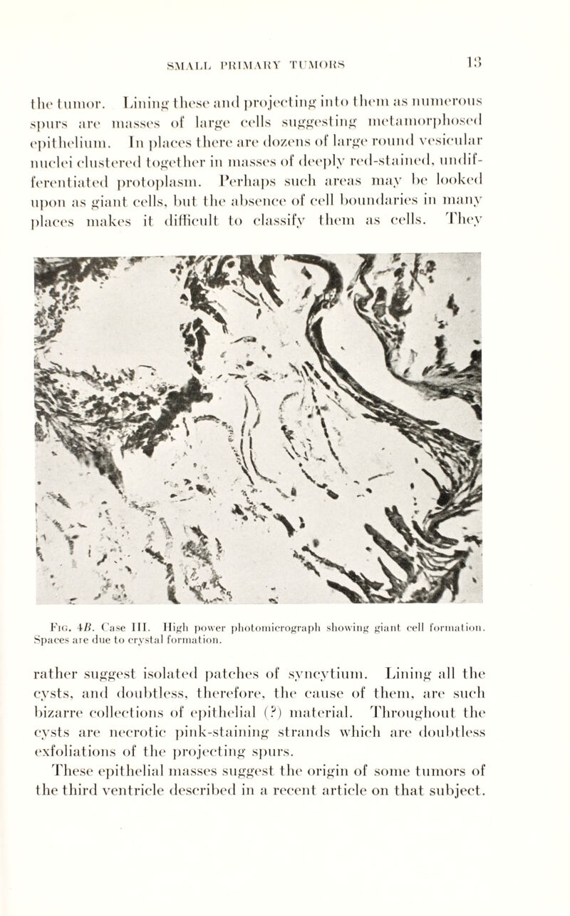 the tumor. Lin inf*' these and projecting into them as numerous spurs are masses of large cells suggesting metamorphosed epithelium. In places there are dozens of large round vesicular nuclei clustered together in masses of deeply red-stained, undit- l’erentiated protoplasm. Perhaps such areas may be looked upon as giant cells, but the absence of cell boundaries in many places makes it difficult to classify them as cells. They Fig, 4B. Case III. High power photomicrograph showing giant cell formation. Spaces are due to crystal formation. rather suggest isolated patches of syncytium. Lining till the cysts, and doubtless, therefore, the cause of them, are such bizarre collections of epithelial (?) material. '’Throughout, the cysts are necrotic pink-staining strands which are doubtless exfoliations of the projecting spurs. 'These epithelial masses suggest the origin of some tumors of the third ventricle described in a recent article on that subject.