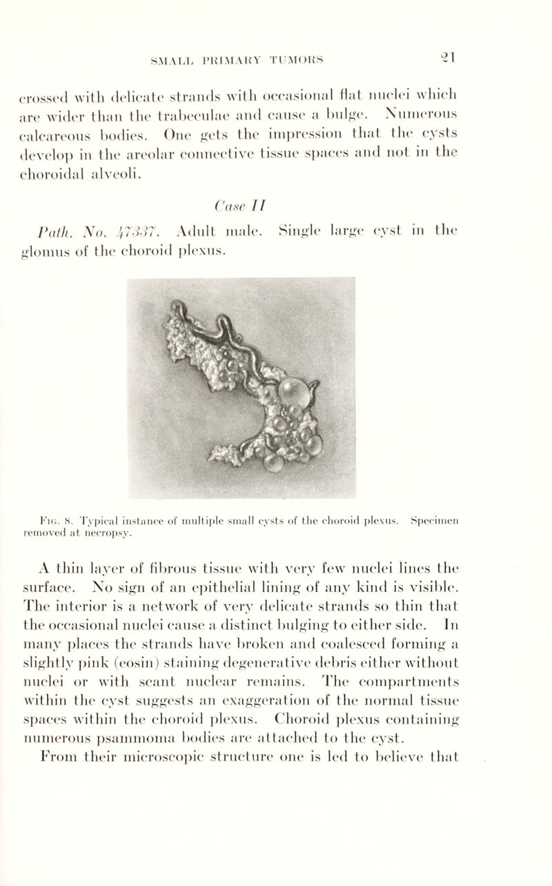 *2 1 crossed with delicate strands with occasional Hat nuclei which are wider than the trabeculae and cause a bulge. Numerous calcareous bodies. One gets the impression that the cysts develop in the areolar connective tissue spaces and not in the choroidal alveoli. Case // Path. No. \7337. Adult male. Single large cyst in the glomus of the choroid plexus. Fie. S. Typical instance of multiple small cysts of the choroid plexus. Specimen removed at necropsy. A thin layer of fibrous tissue with very few nuclei lines the surface. No sign of an epithelial lining of any kind is visible. The interior is a network of very delicate strands so thin that the occasional nuclei cause a distinct bulging to either side. In many places the strands have broken and coalesced forming a slightly pink (eosin) staining degenerative debris either without nuclei or with scant nuclear remains. The compartments within the cyst suggests an exaggeration of tlie* normal tissue spaces within the choroid plexus. Choroid plexus containing numerous psammoma bodies are attached to the cyst. From their microscopic structure one is led to believe that