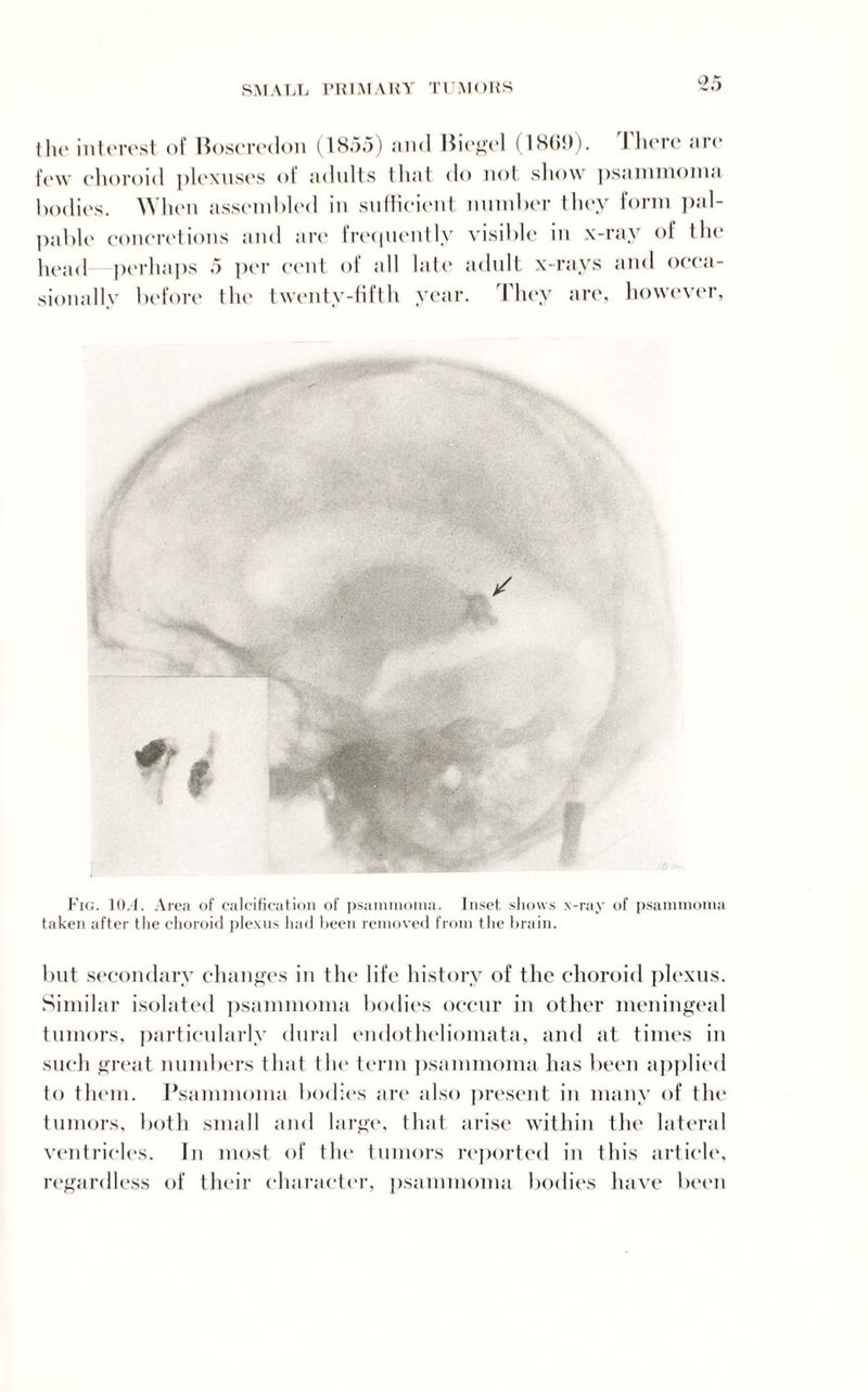 L'.r) the interest of Boscredon (1855) and Biogel (18(5!)). I here are few choroid plexuses of adults that do not show psammoma bodies. When assembled in sufficient number they form pal¬ pable concretions and are lrequently visible in x-ray of the head perhaps 5 per cent of all late adult x-rays and occa- sionallv before the twenty-fifth year. They are, however, Fig. 10.1. Area of calcification of psammoma. Inset shows x-ray of psammoma taken after the choroid plexus had been removed from the brain. but secondary changes in the life history of the choroid plexus. Similar isolated psammoma bodies occur in other meningeal tumors, particularly dural endotheliomata, and at times in such great numbers that the term psammoma has been applied to them. Psammoma bodies are also present in many of the tumors, both small and large, that arise within the lateral ventricles. In most of the tumors reported in this article, regardless of their character, psammoma bodies have been