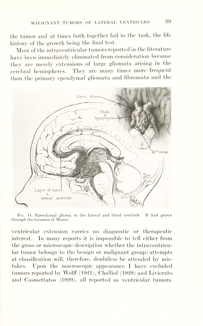 2!) the tumor and at times both together tail in the task, the liie history of the growth being the final test. Most of the intraventricular tumors reported in the literature have been immediately eliminated from consideration because they are merely extensions of large gliomata arising in the cerebral hemispheres. They are many times more frequent than the primary ependymal gliomata and fibromata and the Fig. 11. Ependymal glioma in the lateral and third ventricle. It had grown through the foramen of Monro. ventricular extension carries no diagnostic or therapeutic interest. In many reports it is impossible to tell either from the gross or microscopic description whether the intraventricu¬ lar tumor belongs to the benign or malignant group; attempts at classification will, therefore, doubtless be attended by mis¬ takes. Upon the macroscopic appearance I have excluded tumors reported by Wolff (1921), Challiol (1929) and Livierato and Cosmettatos (1929), all reported as ventricular tumors.