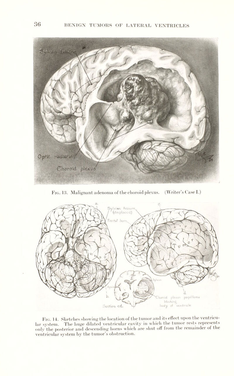 Fig. 13. Malignant adenoma of the choroid plexus. (\\ riter's Case I.) •horoid plexus blocking body of vent a pa pi I lor Fig. I t. Sketches showing the location of the tumor ami its effect upon t he ventricu¬ lar system. The huge dilated ventricular cavity in which the tumor rests represents only the posterior and descending horns which are shut ott Irom the remainder ot the ventricular system by the tumor's obstruction.