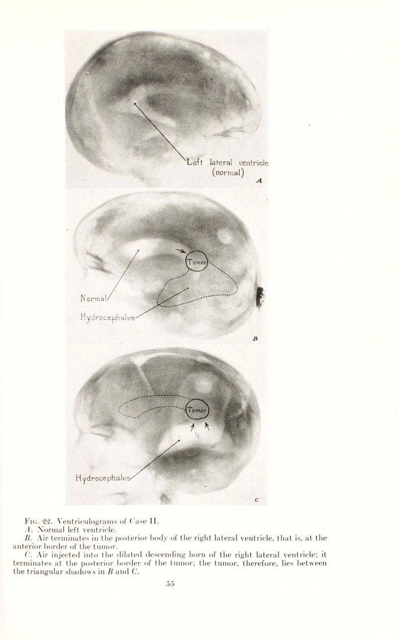 Fig. 22. Ventriculograms of Case II. A. Normal left ventricle. B. Air terminates in the posterior body of the right lateral ventricle, that is, at the anterior border of the tumor. C. Air injected into the dilated descending horn of the right lateral ventricle; it terminates at the posterior border of the tumor; the tumor, therefore, lies between the triangular shadows in li and C.