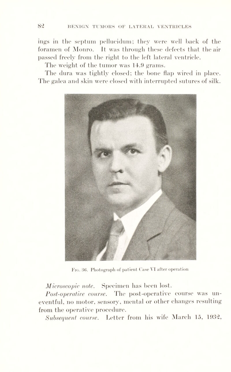iugs in the septum pellucidum; they were well hack of the foramen of Monro. It was through these defects that the air passed freely from the right to the left lateral ventricle. 'The weight of the tumor was 14.!) grams. The dura was tightly closed; the bone flap wired in place. The galea and skin were closed with interrupted sutures of silk. m Fig. 36. Photograph of patient Case \ I after operation Microscopic note. Specimen has been lost. Post-operative coarse. The post-operative course was un¬ eventful. no motor, sensory, mental or other changes resulting from the operative procedure. Subsequent course. Letter from his wife March 15, 1!>8-,