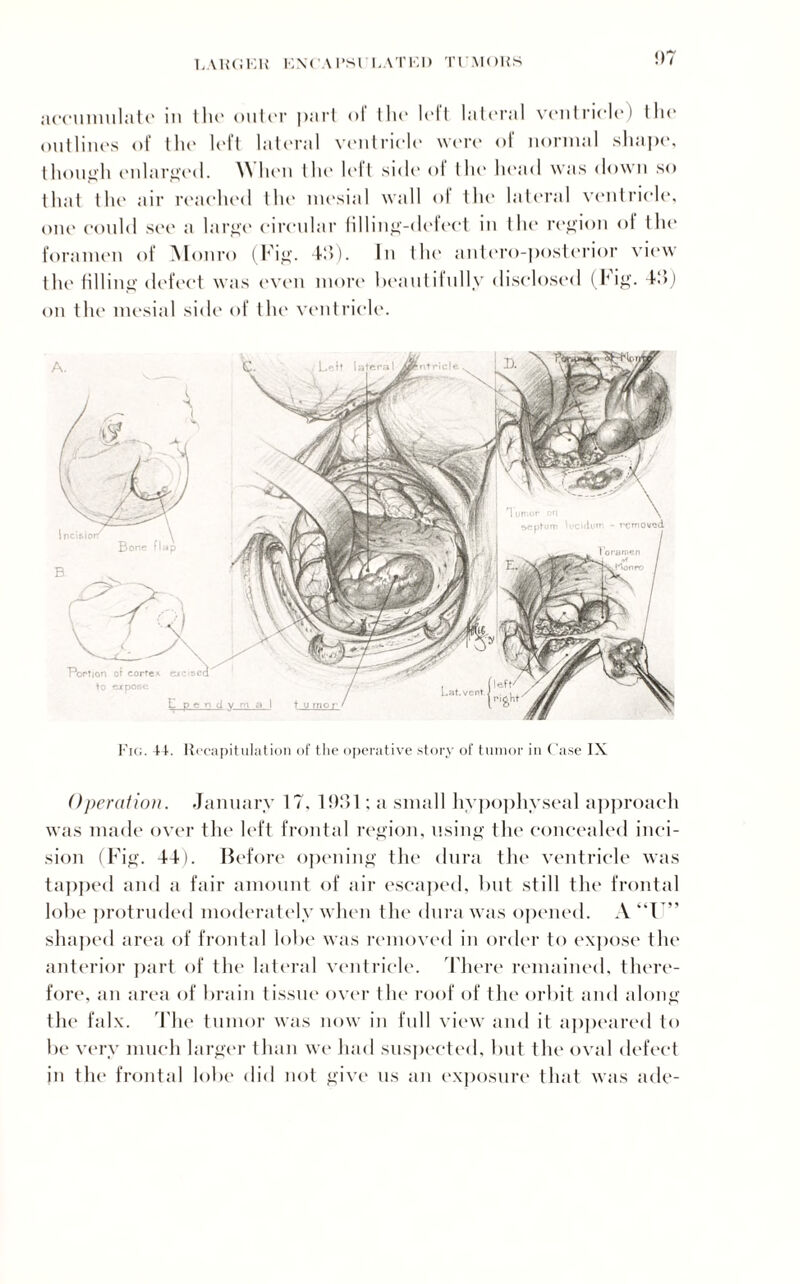 LARCiKH KNCAI’SlI.ATFI) TUMORS accumulate in the outer part oi the loll lateral ventriele) the outlines of the left lateral ventriele were of normal shape, though enlarged. \\ hen the loll side ol the head was down so that the air reached the mesial wall oi the lateral ventricle, one could see a large circular filling-defect in the region of the foramen of Monro (Fig. 415). In the antero-posterior view the filling defect was even more beautifully disclosed (Fig. 43) on the mesial side of the ventricle. Fig. 44. Recapitulation of the operative story of tumor in Case IX Operation. January 17. 1931; a small hypophyseal approach was made over the left frontal region, using the concealed inci¬ sion (Fig. 44). Before opening the dura the ventricle was tapped and a fair amount of air escaped, but still the frontal lobe protruded moderately when the dura was opened. A “I” shaped area of frontal lobe was removed in order to expose the anterior part of the lateral ventricle. There remained, there¬ fore, an area of brain tissue over the roof of the orbit and along the falx. The tumor was now in full view and it appeared to be very much larger than we had suspected, but the oval defect jn the frontal lobe did not give us an exposure that was ade-