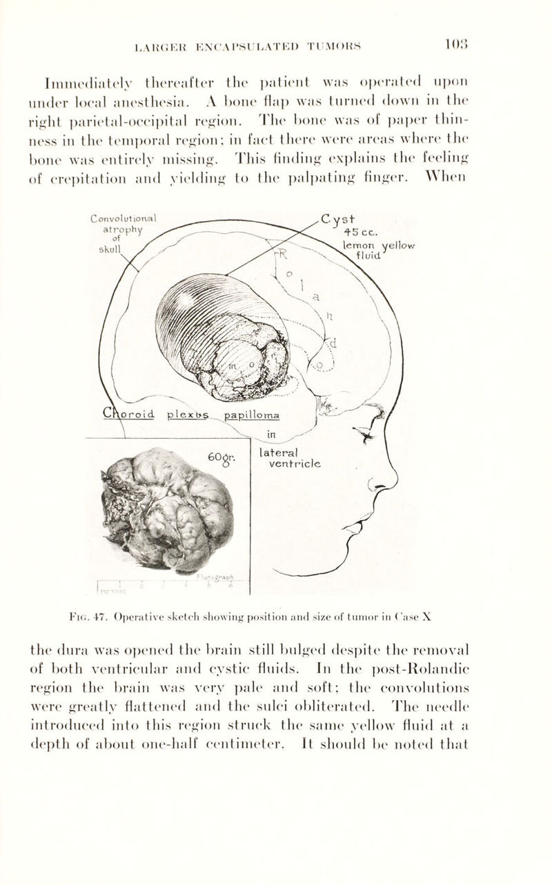 UAUGEU K\(’.\ l’Sl'EATEI) Tl MOWS Immediately thereafter the patient was opera led upon under local anesthesia. A bone (lap was turned down in the right parietal-occipital region. The bone was ol paper thin¬ ness in the temporal region: in fact there were areas where the bone was entirely missing. This finding explains the feeling of crepitation and yielding to the palpating finger. When Convolutional atrophy of lemon yellow ' fluid' Fig. 47. Operative sketch showing position and size of tumor in Case X the dura was opened the brain still bulged despite the removal of both ventricular and cystic fluids. In the post-Rolandic region the brain was very pale and soft; the convolutions were greatly flattened and the sulci obliterated. The needle introduced into this region struck the same yellow fluid at a depth of about one-half centimeter. It should be noted that