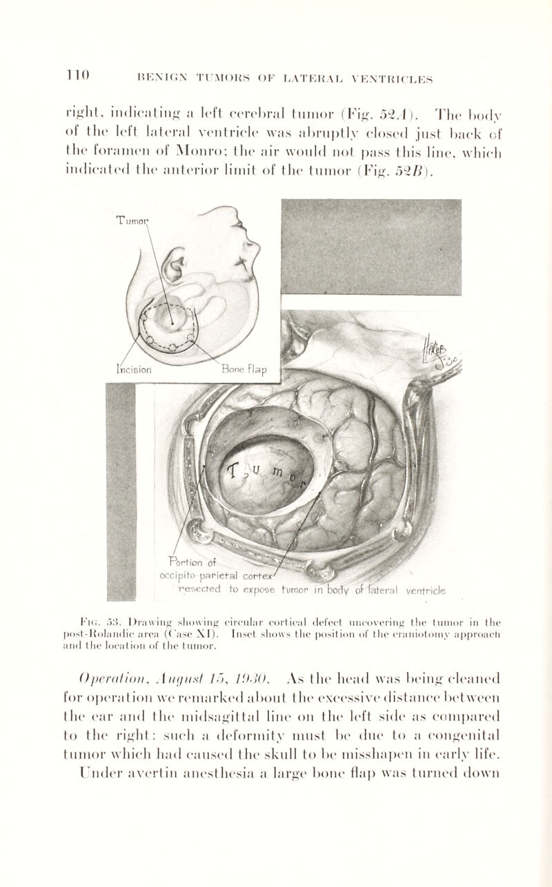 right, indicating a left cerebral tumor (Fig. 52/1). The body of Ihe left lateral ventricle was abruptly closed just back of 1 he f oranien of Monro; the air would not pass this line, which indicated the anterior limit of the tumor (Fig. 52/?). Flea !iii. Drawing showing circular cortical defect uncovering the tumor in the post-Rolandic area (Case XI). Inset shows the position of the craniotomy approach and the location of the tumor. I leration, Auguxt /5, !!)■{(). As the1 head w;is being cleaned for operat ion we remarked about l lit' excessive distance bet ween lilt' ear and tIn* midsagittal lint* on the left side as compared to the right: such a deformity must be due to a congenital tumor which Imd caused tin* skull to be misshapen in early life. I Aider avert in anesthesia a large bone flap was turned down