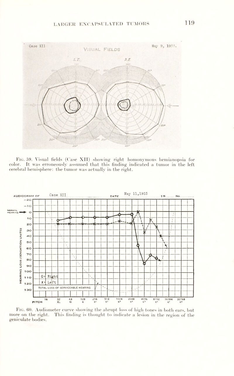 LAHCJER i:\C\PSri.ATKI) TI MOHS Case XII May 9, Visual Fields L.r. p£. Fig. 59. Visual fields (Case XII) showing right homonymous hemianopsia for color. It was erroneously assumed that this finding indicated a tumor in the left cerebral hemisphere: the tumor was actually in the right. 16 32 64 128 256 512 1024 2048 4096 8192 16384 32768 PITCH C, C C C' c* Cl c« c' c« c» c8 Fig. 00. Audiometer curve showing the abrupt loss of high tones in both ears, but more on the right. This finding is thought to indicate a lesion in the region of the geniculate bodies.
