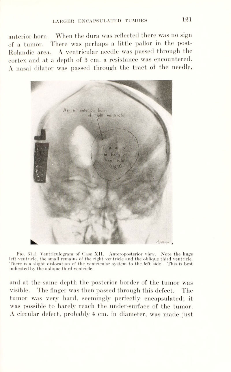 anterior horn. When the dura was reflected there was no sign of a tumor. There was perhaps a little pallor in tin* post- Uolandic area. A ventricnlar needle was passed through I In* cortex and at a depth of 5 cm. a resistance was encountered. A nasal dilator was passed through the tract of tin* needle, Air in anterior horn of ri£ht ventricle i u m o r : in body of / ventricle.. /$> \ \ y' \ ■ > Hi'-. p*;. •; in. V v : ' ' Fig. 61.-1. Ventriculogram of Case XII. Anteroposterior view. Note the hope left ventricle, the small remains of the right ventricle and the oblique third ventricle. 'There is a slight dislocation of the ventricular system to the left side. This is best indicated by the oblique third ventricle. and tit tilt' same depth the posterior border of the tumor was visible. The finger was then passed through this defect. The tumor was very hard, seemingly perfectly encapsulated; it was possible to barely reach the under-surface of the tumor. A circular defect, probably 4 cm. in diameter, was made just
