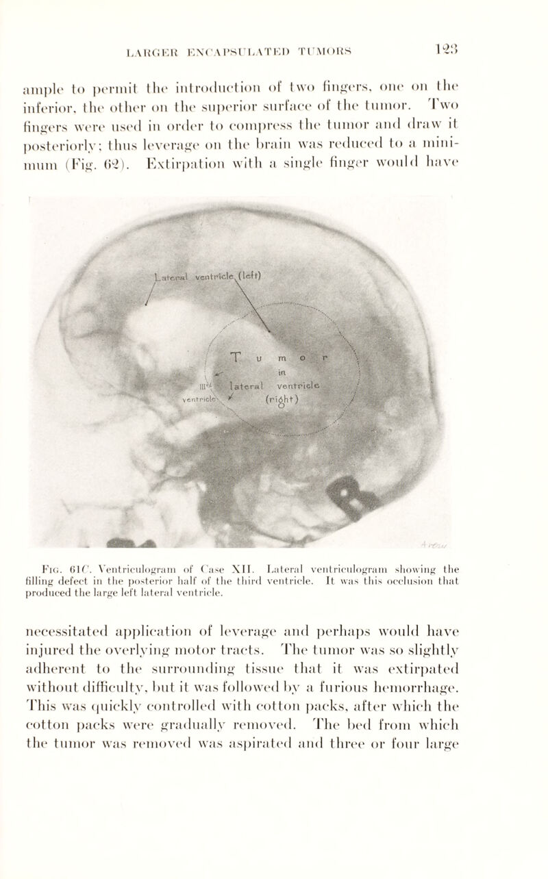 LAKCJKH l'.NCAI’Sl I,ATKI) TlMOliS 1 ample to permit the introduction of two fingers, one on the inferior, the other on the superior surface of the tumor. I wo fingers were used m order to compress tlu* tumor and draw it posteriorly; thus leverage on the* drain was reduced to a mini¬ mum (Fig. 6*2). Extirpation with a single finger would have T u m o r in 111** ' lateral ventricle ventricle',. ** (night) ■ Fig. 61C. Ventriculogram of Case XII. Lateral ventriculogram showing the tilling defect in the posterior half of the third ventricle. It was this occlusion that produced the large left lateral ventricle. necessitated application of leverage and perhaps would have injured the overlying motor tracts. The tumor was so slightly adherent to the surrounding tissue that it was extirpated without difficulty, hut it was followed by a furious hemorrhage. Phis was quickly controlled with cotton packs, after which the cotton packs were gradually removed. The bed from which the tumor was removed was aspirated and three or four large