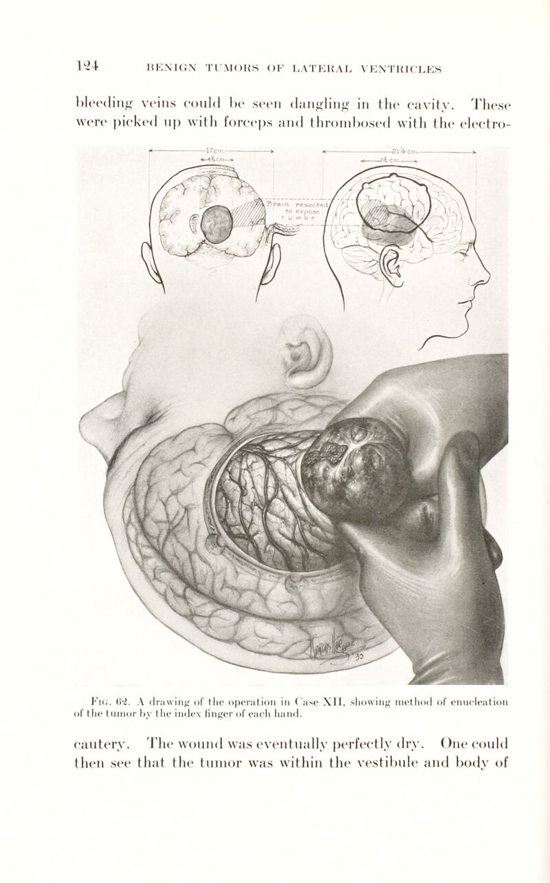 K>4 bleeding veins could be seen dangling in the cavity. These were picked up with forceps and thrombosed with the electro- Ki(i. O'i. A drawing of the operation in Case XU, showing method of enucleation of the tumor by the index finger of each hand. cautery. The wound was eventually perfectly dry. One could then see that the tumor was within the vestibule and body of