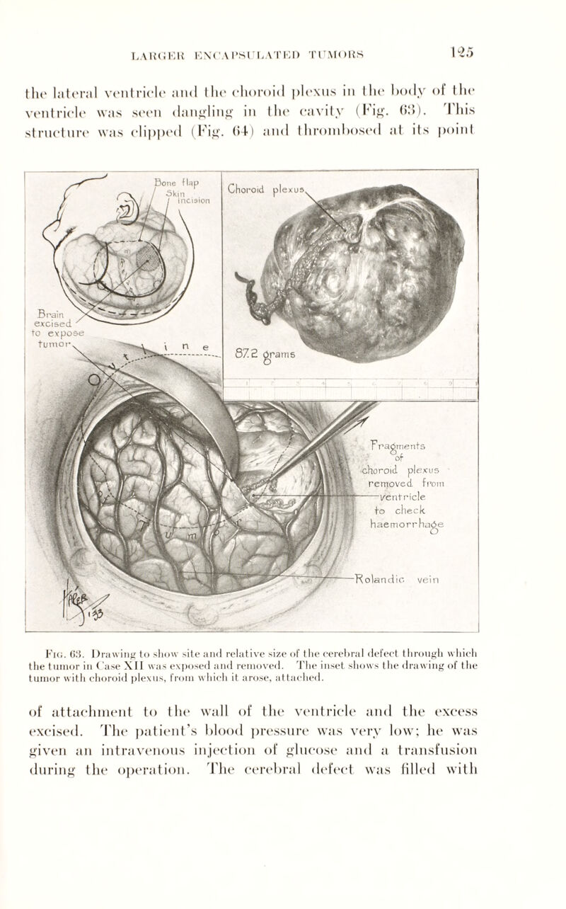 LAHCKK ENCA I’SU FATED TUMORS the lateral ventricle ami the choroid plexus in the body of the ventricle was seen dandling in the cavity (Fig. (>;>). I his structure was clipped (Fig. (>4) and thrombosed at its point to expose tumor Y ragrnents of choroid, plexus removed from ricle to check haemorrhage O vein Choroid plexus 872 gram 5 Fig. OS. Drawing to show site and relative size of the cerebral defect through which the tumor in Case XII was exposed and removed. The inset shows the drawing of the tumor with choroid plexus, from which it arose, attached. of attachment to the wall of the ventricle and the excess excised. The patient’s blood pressure was very low; he was given tin intravenous injection of glucose and a transfusion during the operation. The cerebral defect was filled with