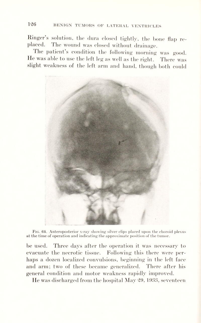 F2(> Ringer’s solution, the dura closed tightly, the hone flap re¬ placed. The wound was closed without drainage. I he patients condition the following morning was good. He was able to use the left leg as well as the right. There was slight weakness of the left arm and hand, though both could Fig. 04. Anteroposterior x-ray showing silver clips placed upon the choroid plexus at the time of operation and indicating the approximate position of the tumor. be used. Three days after the operation it was necessary to evacuate the necrotic tissue. Following this there were per¬ haps a dozen localized convulsions, beginning in the left face and arm; two of these became generalized. There after his general condition and motor weakness rapidly improved. He Wits discharged from the hospital May 2A, 1 !):>;>, seventeen
