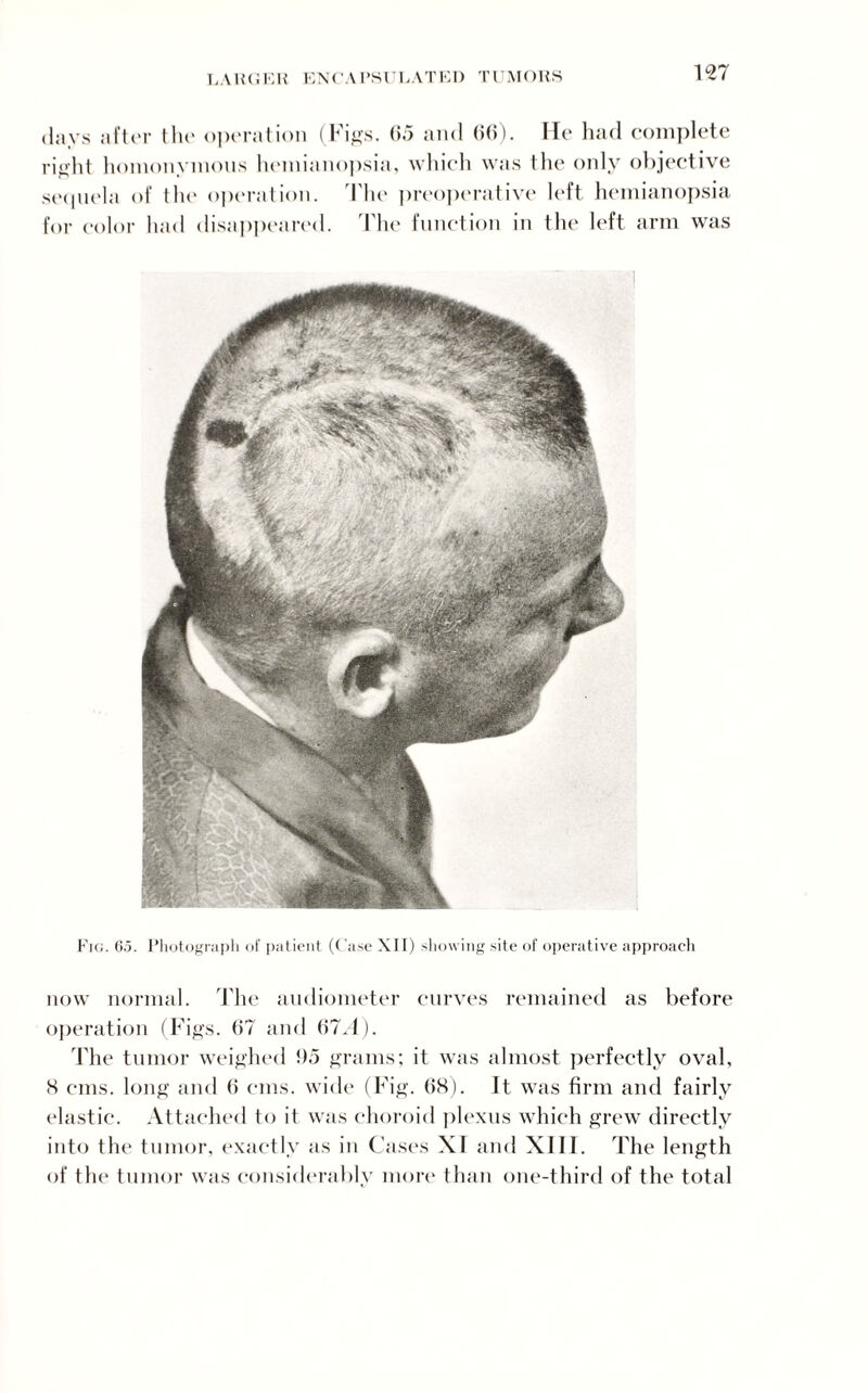 LARGER ENCAPSULATED tumors days after the o|)eration (Figs. 65 and 66). He had complete right homonymous hemianopsia, which was the only objective sequela of the operation. The preoperative left hemianopsia for color had disappeared. The function in the left arm was Fig. 6.5. Photograph of patient (Case XII) showing site of operative approach now normal. The audiometer curves remained as before operation (Figs. 67 and 67.4). The tumor weighed !)5 grams; it was almost perfectly oval, <S cms. long and 6 cms. wide (Fig. 68). It was firm and fairly elastic. Attached to it was choroid plexus which grew directly into the tumor, exactly as in Cases XI and XIII. The length of the tumor was considerably more than one-third of the total