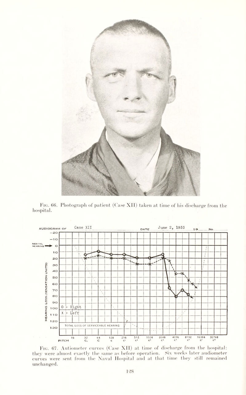 Fig. 66. Photograph of patient (Case XII) taken at time of his discharge from the hospital. 16 32 64 128 256 512 1024 2048 4096 8192 16384 32768 PITCH C, C C C> C' c> c' 4' c» c* c» Fig. 67. Aiiliometer curves (Case XII) at time of discharge from the hospital: they were almost exactly the same as before operation. Six weeks later audiometer curves were sent from the Naval Hospital and at that time they still remained unchanged.