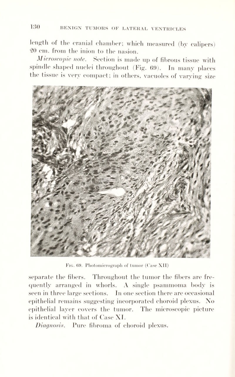 1.S0 length of the cranial chamber; which measured (by calipers) 20 cm. from the inion to the nasion. Microscopic note. Section is made up of fibrous tissue with spindle shaped nuclei throughout (Fig. (>!)). In many places the tissue is very compact; in others, vacuoles of varying size Fig. (50. Photomicrograph of tumor (Case XII) separate the fibers. Throughout the tumor the fibers are fre¬ quently arranged in whorls. A single psammoma body is seen in three large sections. In one section there are occasional epithelial remains suggesting incorporated choroid plexus. No epithelial layer covers the tumor. The microscopic picture is identical with that of Case XI. Diagnosis. Pure fibroma of choroid plexus.