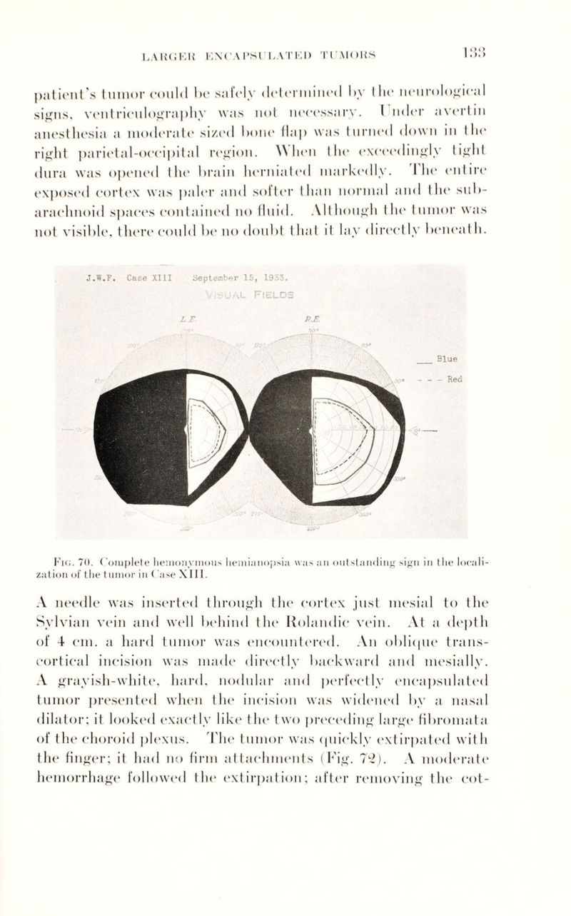 LAIUJKW KM’AI’Sl CAT101) TI'.MOKS patient’s tumor could be safely determined by the neurological signs, ventriculography was not necessary. 1 nder avertin anesthesia a moderate sized bone flap was turned down in the right parietal-occipital region. When tin* exceedingly tight dura was opened the brain herniated markedly. I he entire exposed cortex was paler and softer than normal and the sub¬ arachnoid spaces contained no fluid. Although tin' tumor was not visible, t here could be no doubt that it lay directly beneath. J.W.F. Case XIII September 15, 1953. Visual Fields if pj-. Fig. 70. Complete hemonvmous hemianopsia was an outstanding sign in the locali¬ zation of the tumor in ( use XIII. A needle was inserted through the cortex just mesial to the Sylvian vein and well behind the Rolandic vein. At a depth of -t cm. a hard tumor was encountered. An oblique trans¬ cortical incision was made directly backward and mesially. A grayish-white, hard, nodular and perfectly encapsulated tumor presented when the incision was widened by a nasal dilator: it looked exactly like the two preceding large fibromata of the choroid plexus. The tumor was quickly extirpated with the finger; it had no firm attachments (Fig. 72). A moderate hemorrhage followed the extirpation; after removing the cot-