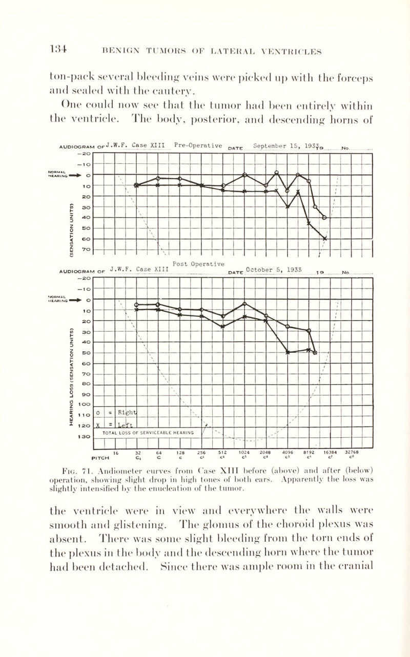 ton-pack several bleeding veins were picked np with the forceps and sealed with the cautery. One could now see that the tumor had been entirely within the ventricle. I he body, posterior, and descending horns of audiogram Case XIII Pre-Operative DATE September 15, 193^9 16 32 64 128 256 512 1024 2048 4096 8192 16384 32768 PITCH C, C c c> cl cl d cl c‘ c’ O Fig. 71. Audiometer curves from Case XIII before (above) and after (below) operation, showing slight drop in high tones of both ears. Apparently the loss was slightly intensified by the enucleation of the tumor. the ventricle were in view and everywhere the walls were smooth and glistening. The glomus of the choroid plexus was absent. There was some slight bleeding from the torn ends of the plexus in tin* body and the descending horn where t he tumor had been detached. Since there was ample room in the cranial