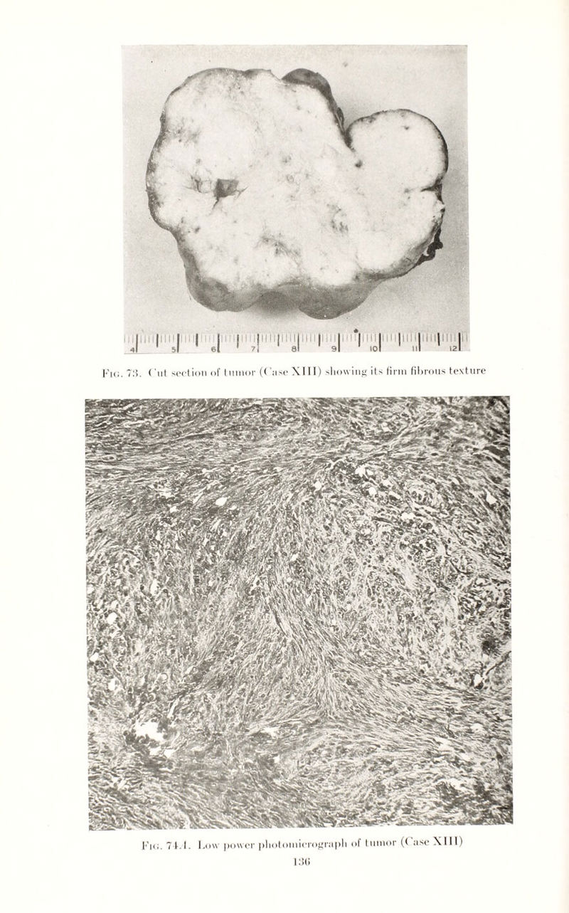 Fkj. 71.1. Low power photomicrograph of tumor (( ase XIII) 13G