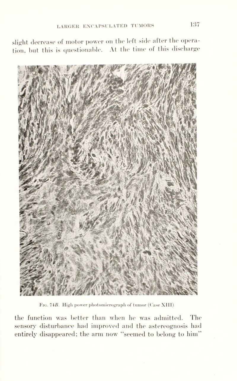 LARGER EXCAPSl'RATED Tl MORS 1 0*7 I •> / slight decrease of motor power on the left side alter the opera¬ tion. but this is questionable. At the time of this discharge Fig. 74/i. High power photomicrograph of tumor (Case XIII) the function was better than when lie was admitted. The sensory disturbance had improved and the astereognosis had entirely disappeared; the arm now “seemed to belong to him”