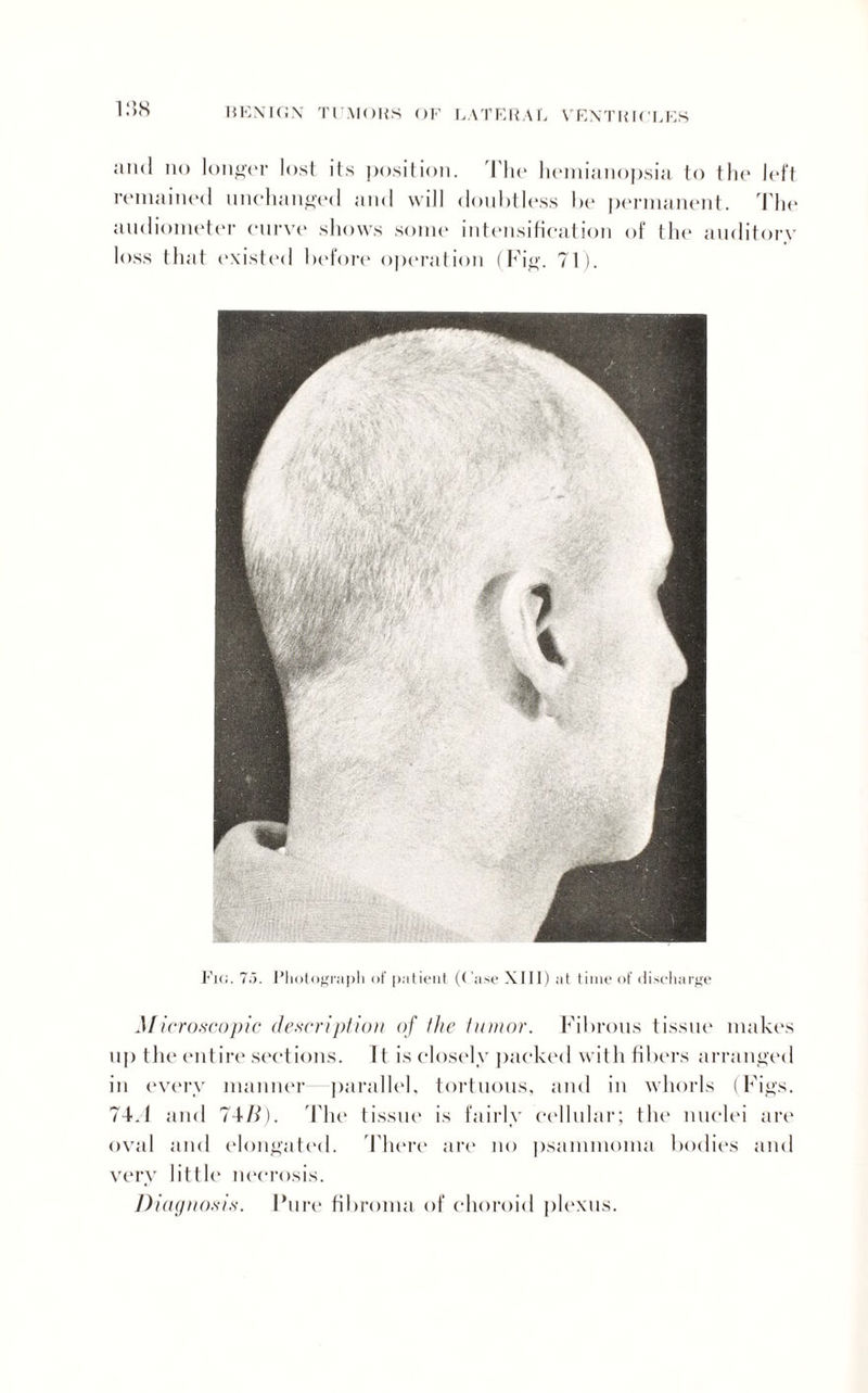 and no longer lost its position. The hemianopsia to the left remained unchanged and will doubtless he permanent. The audiometer curve shows some intensification of the auditory loss that existed before operation (Fig. 71). Fic;. 7.5. Photograph of patient (Case XIII) at time of discharge Microscopic description of the tumor. Fibrous tissue makes up the entire sections. It is closely packed with fibers arranged in every manner parallel, tortuous, and in whorls (Figs. 74J and 74/f). 'The tissue is fairly cellular; the nuclei are oval and elongated. There art* no psammoma bodies and very little necrosis. Diagnosis. Pure fibroma of choroid plexus.