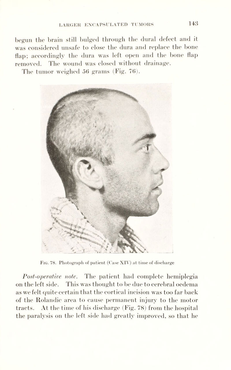 148 begun the brain still bulged through the dural defect and it was considered unsafe to close the dura and replace the bone flap; accordingly the dura was left open and the bone flap removed. The wound was closed without drainage. 'The tumor weighed 50 grams (Fig. 7(5). Fig. 78. Photograph of patient (Case XIV ) at time of discharge Post-operative note. The patient, had complete hemiplegia on the left side. This was thought to be due to cerebral oedema as we felt quite certain that the cortical incision was too far back of the Rolandic area to cause permanent injury to the motor tracts. At the time of his discharge (Fig. 78) from the hospital the paralysis on the left side had greatly improved, so that he