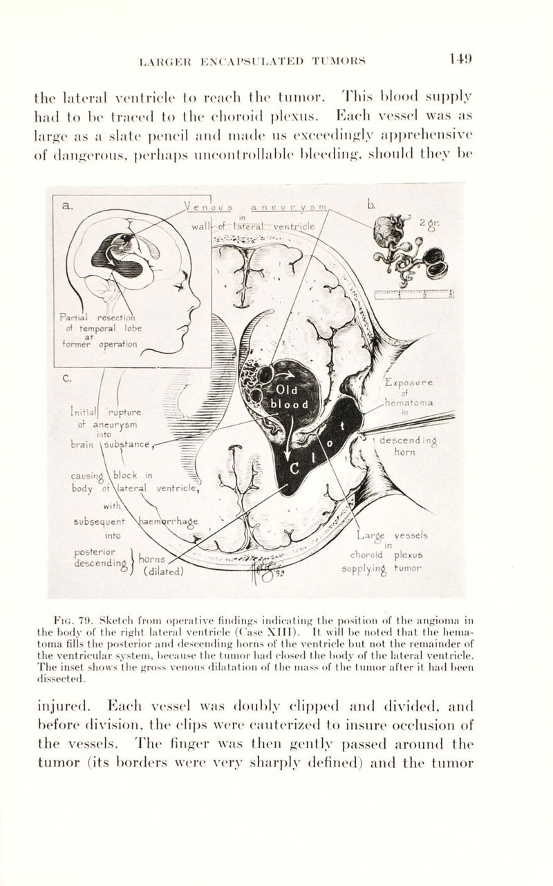 14!) the lateral ventricle to reach the tumor. Phis blood supply had to be traced to I ho choroid plexus. Each vessel was as large as a slate pencil and made us exceedingly apprehensive of dangerous, perhaps uncontrollable bleeding, should they be arrte vessels ^ in choroid plexus supplying Junior xposu re of hematoma descendi ng horn wall of temporal lobe at former operation C‘ / / InitialJ rupture of aneurysm into brain causing body of subsequent into posterior > , ‘‘““ndid (°2.cd) Fig. 79. Sketch from operative findings indicating the position of the angioma in the body of the right lateral ventricle (Case XIII). It will be noted that the hema¬ toma fills the posterior and descending horns of the ventricle hut not the remainder of the ventricular system, because the tumor had closed the body of the lateral ventricle. The inset shows the gross venous dilatation of the mass of the tumor after it had been dissected. injured. Each vessel was doubly clipped and divided, and before division, the clips were cauterized to insure occlusion of the vessels. The finger was then gently passed around the tumor (its borders were very sharply defined) and the tumor